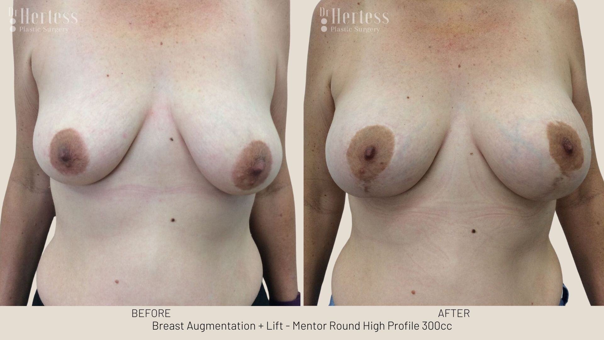 implants and lift before and after