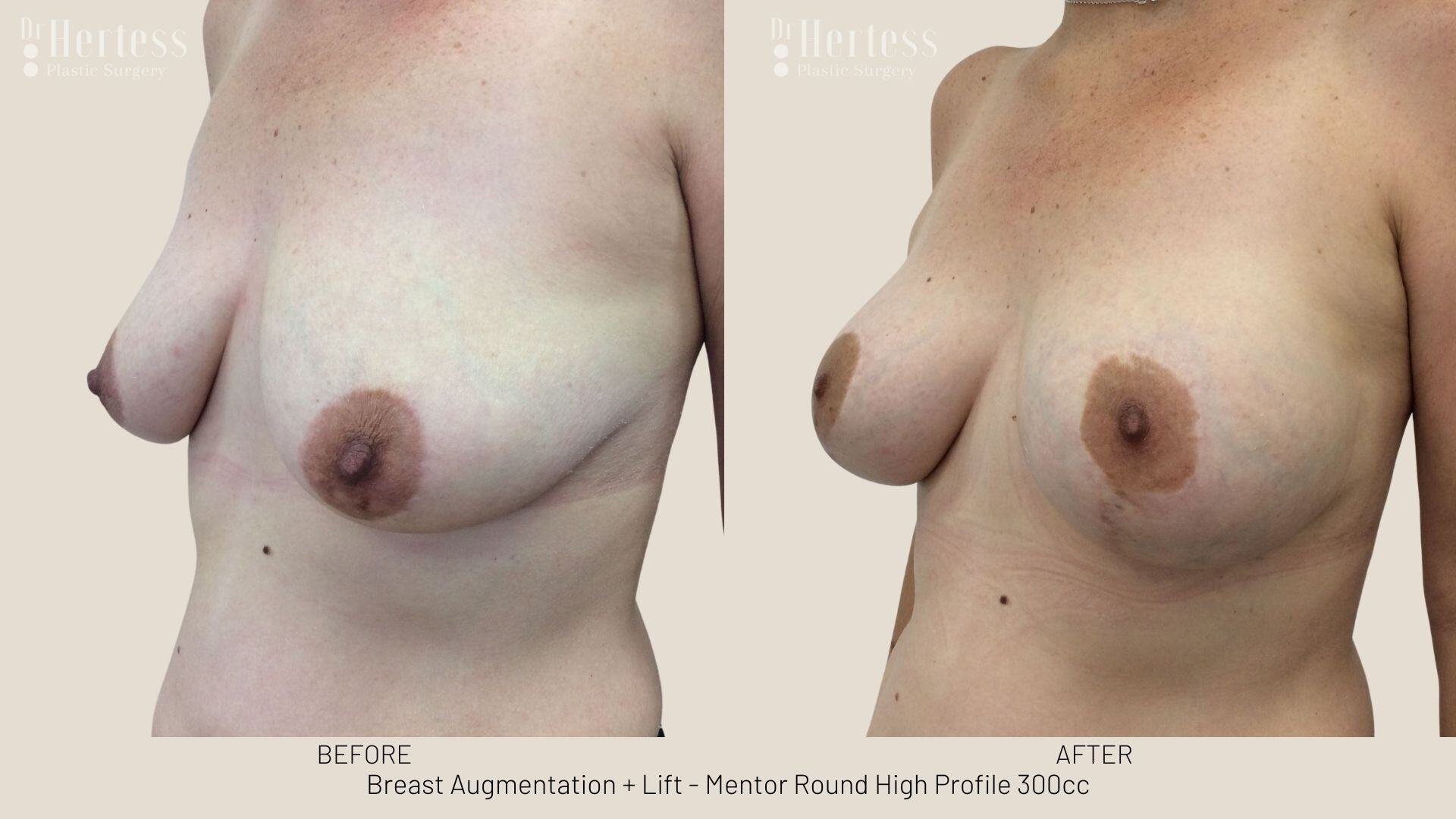 implants and lift before and after