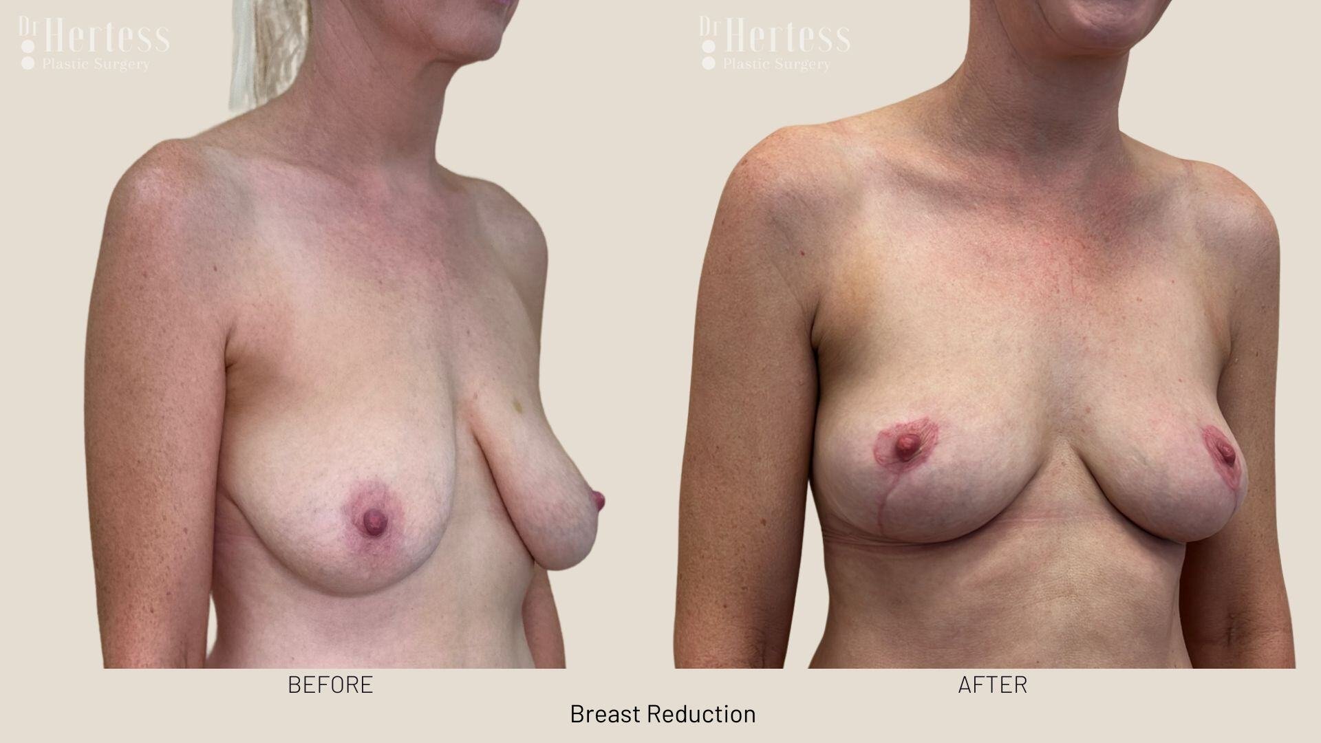 breast reduction before and after