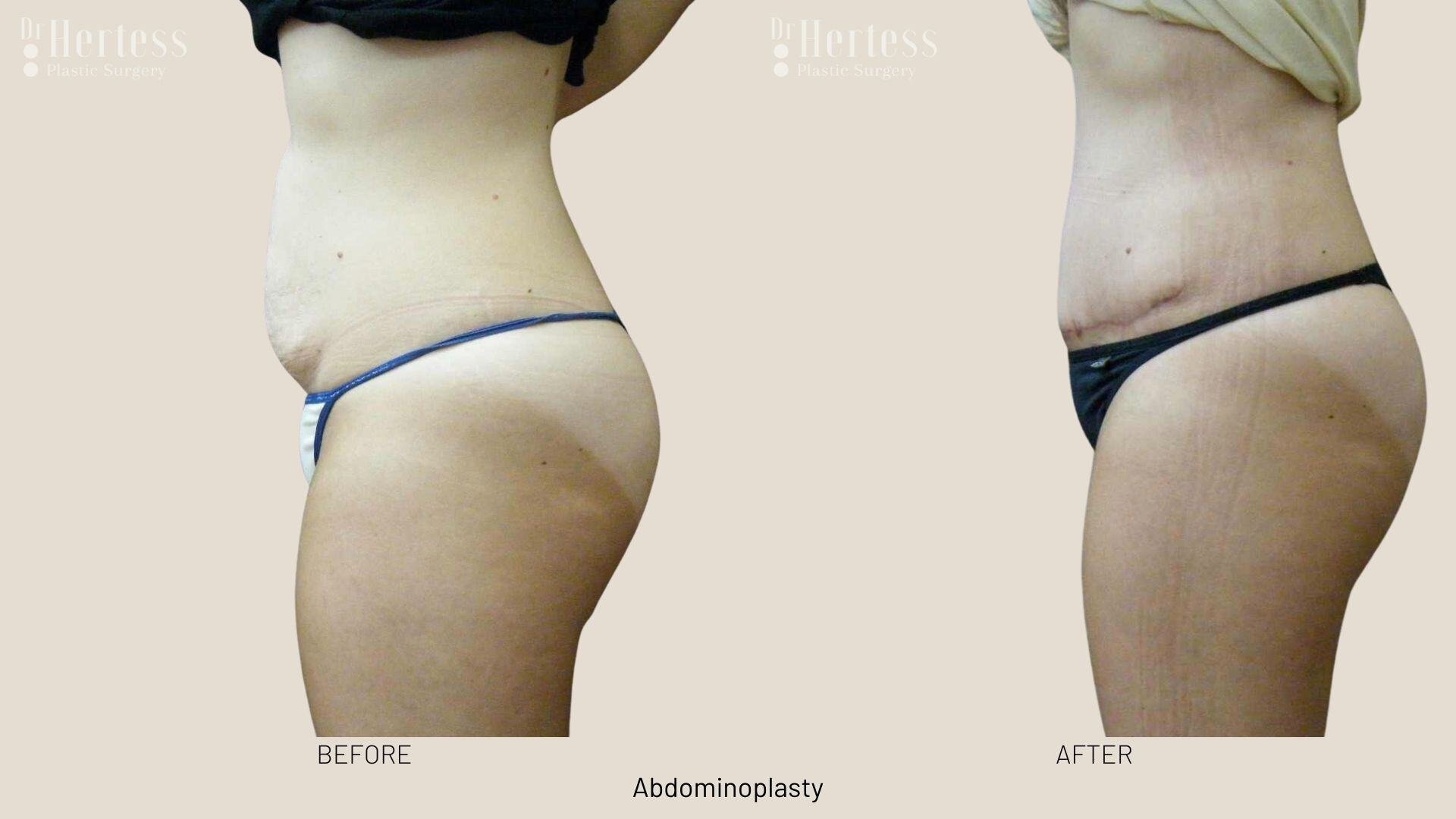 abdominoplasty before and after photos