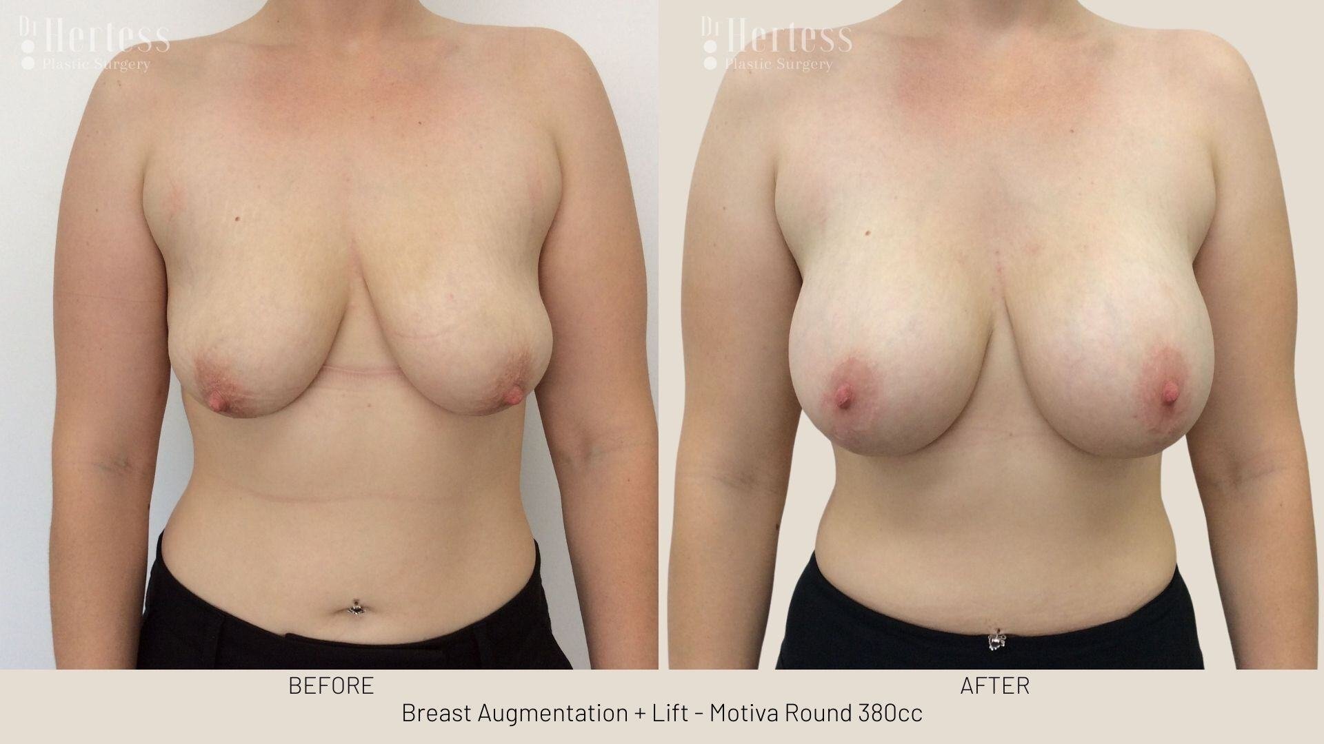 implants and lift before and after