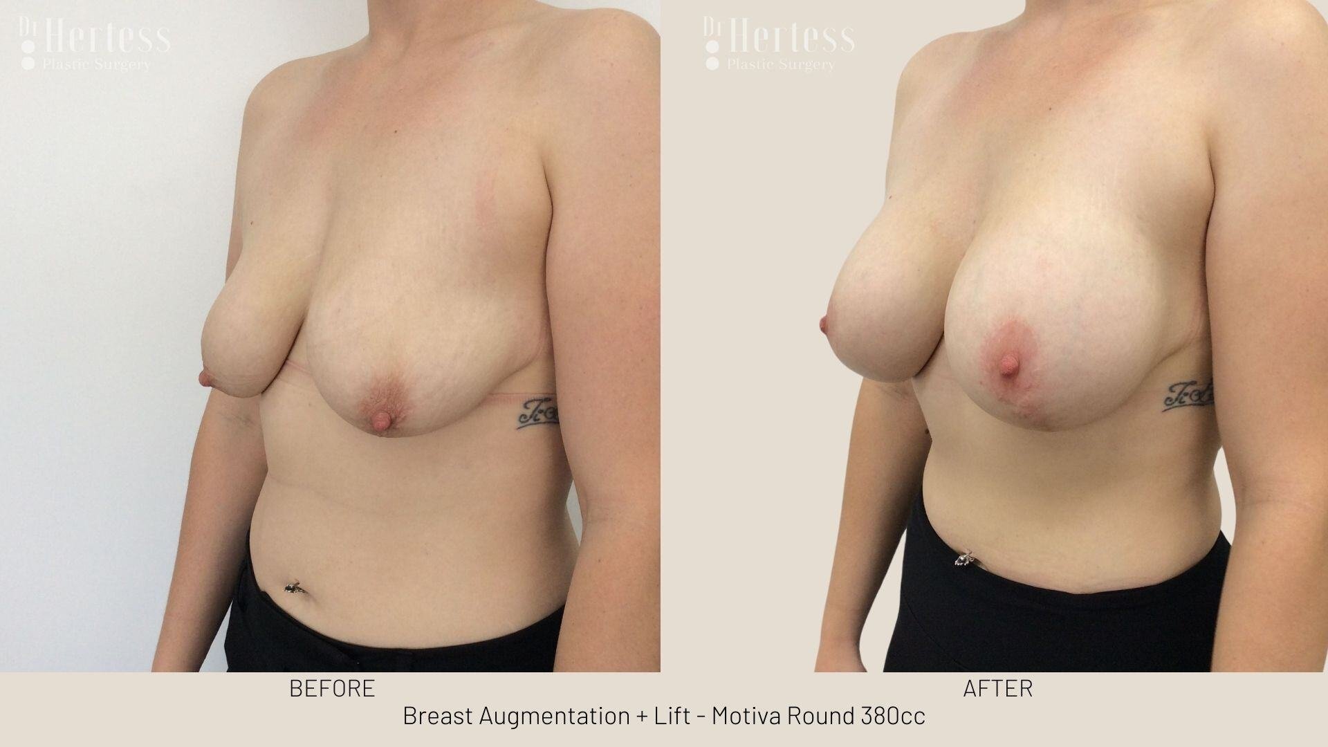 implants and lift before and after