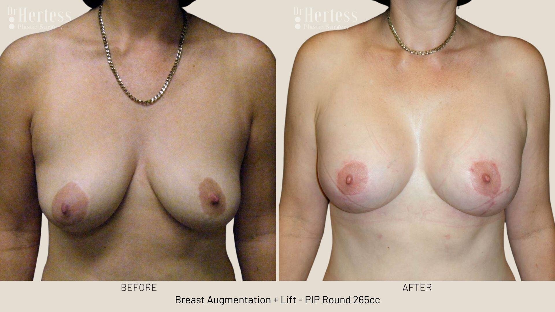 implants and lift before and after