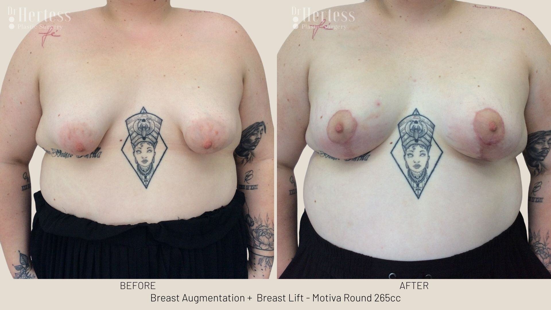 implants and lift before and after