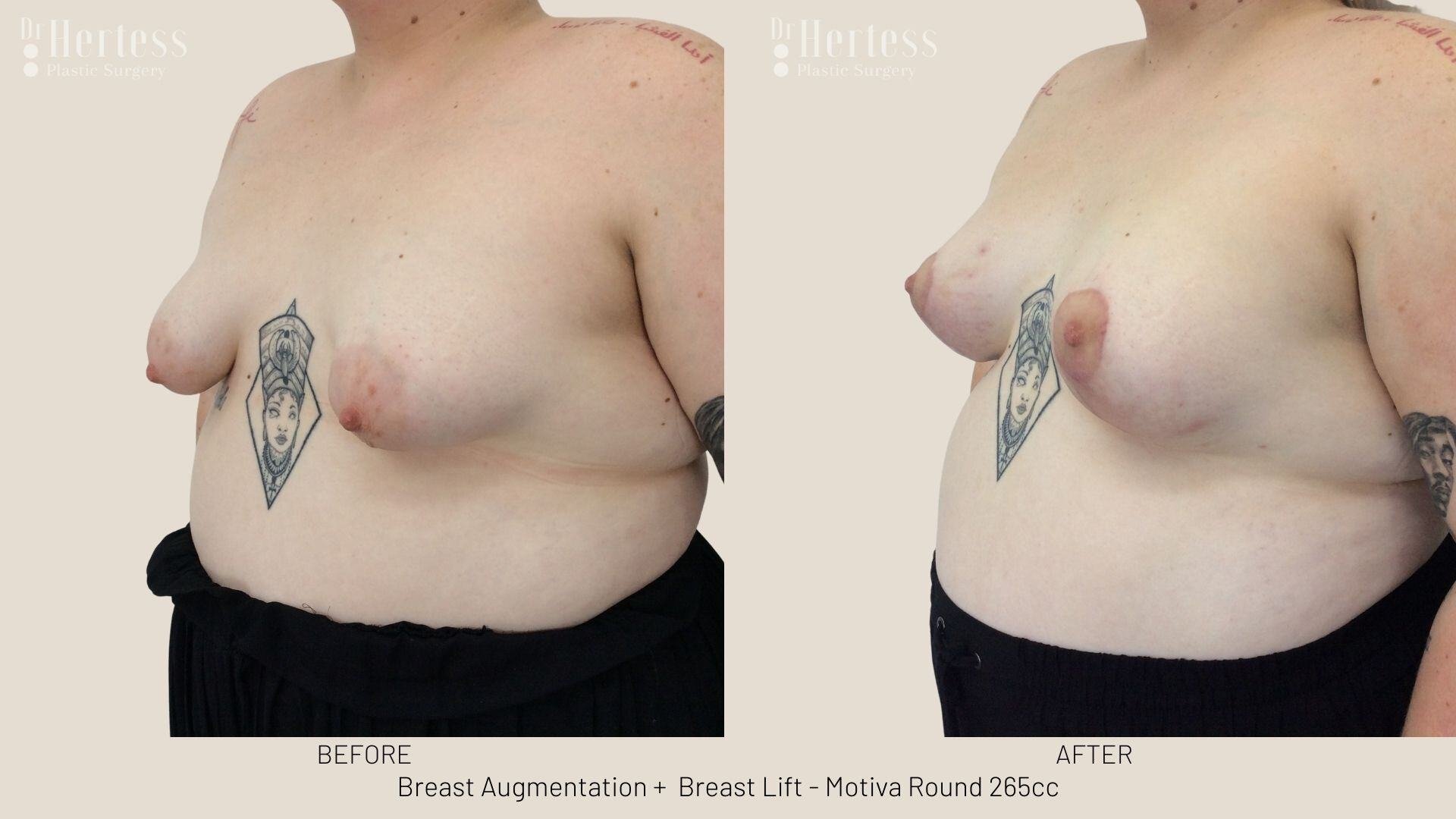 implants and lift before and after