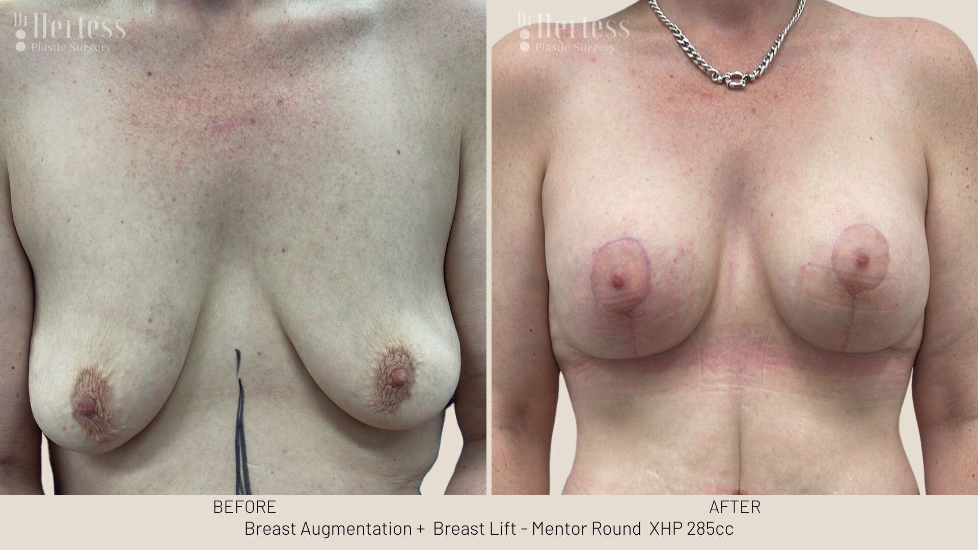 implants and lift before and after