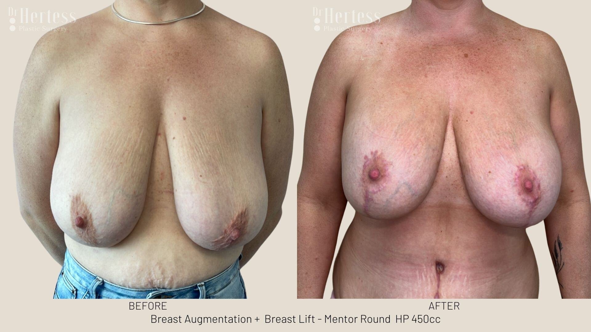 implants and lift before and after