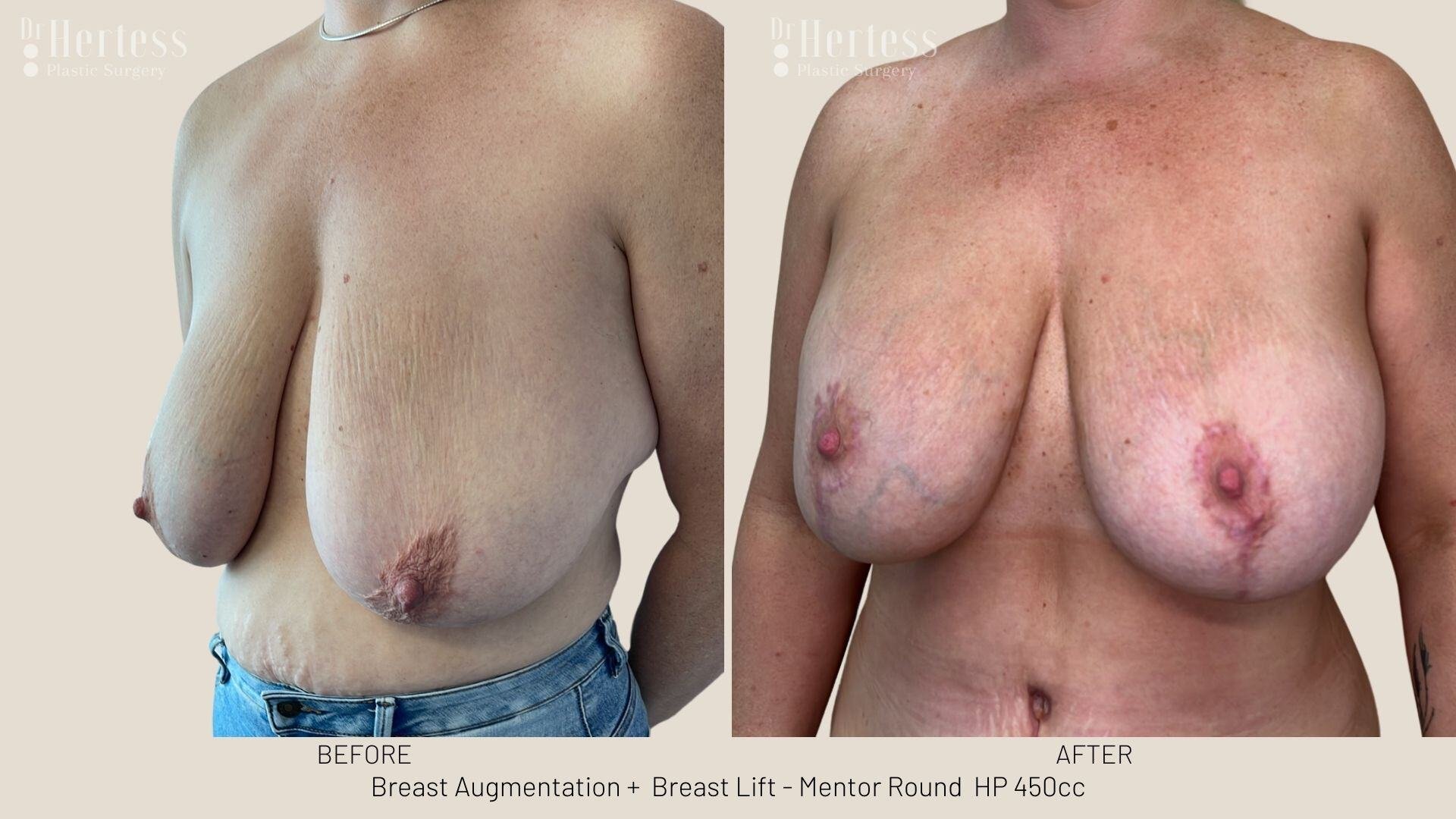 implants and lift before and after