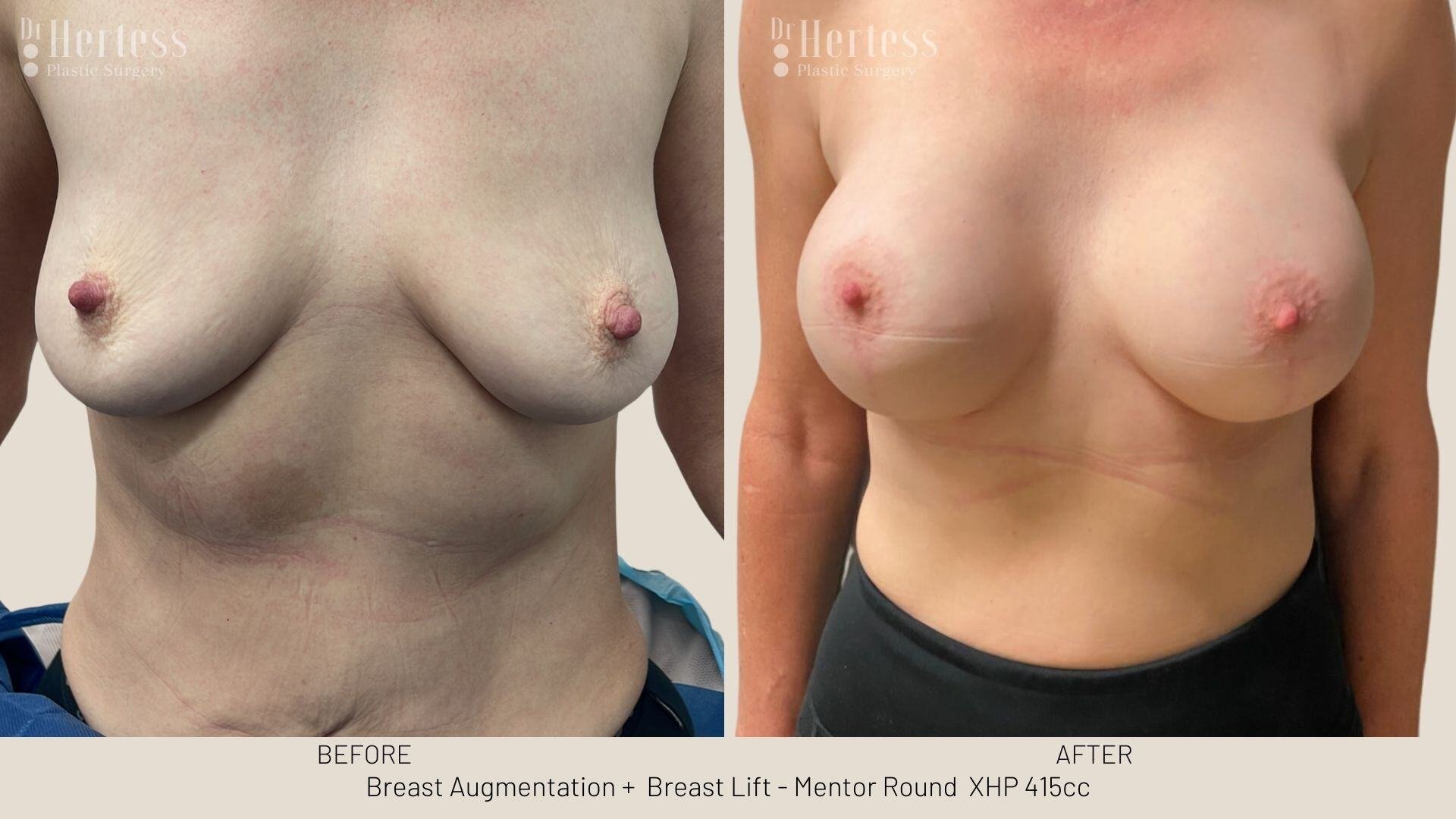 implants and lift before and after