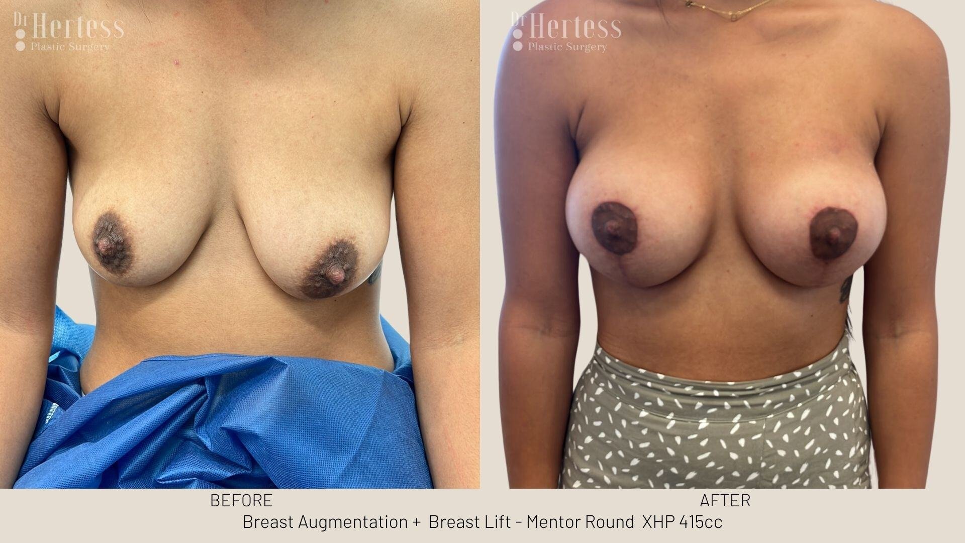 implants and lift before and after