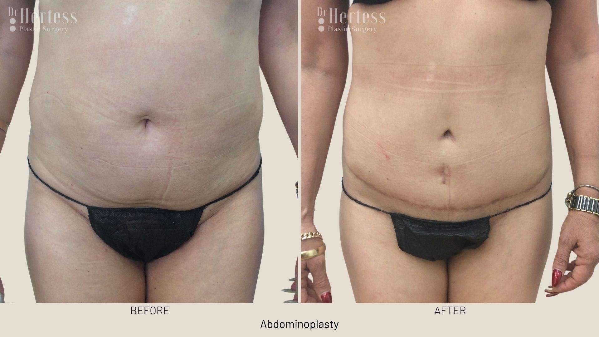 abdominoplasty before and after photos
