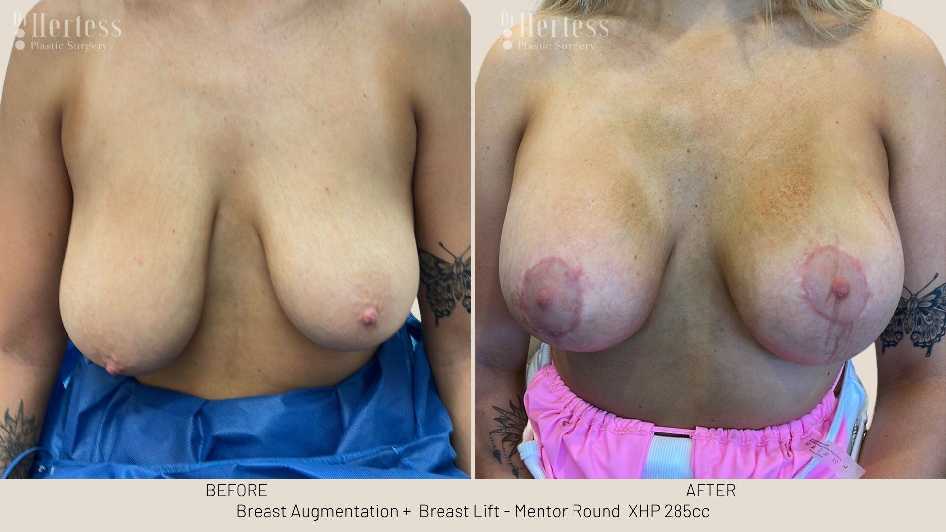 implants and lift before and after