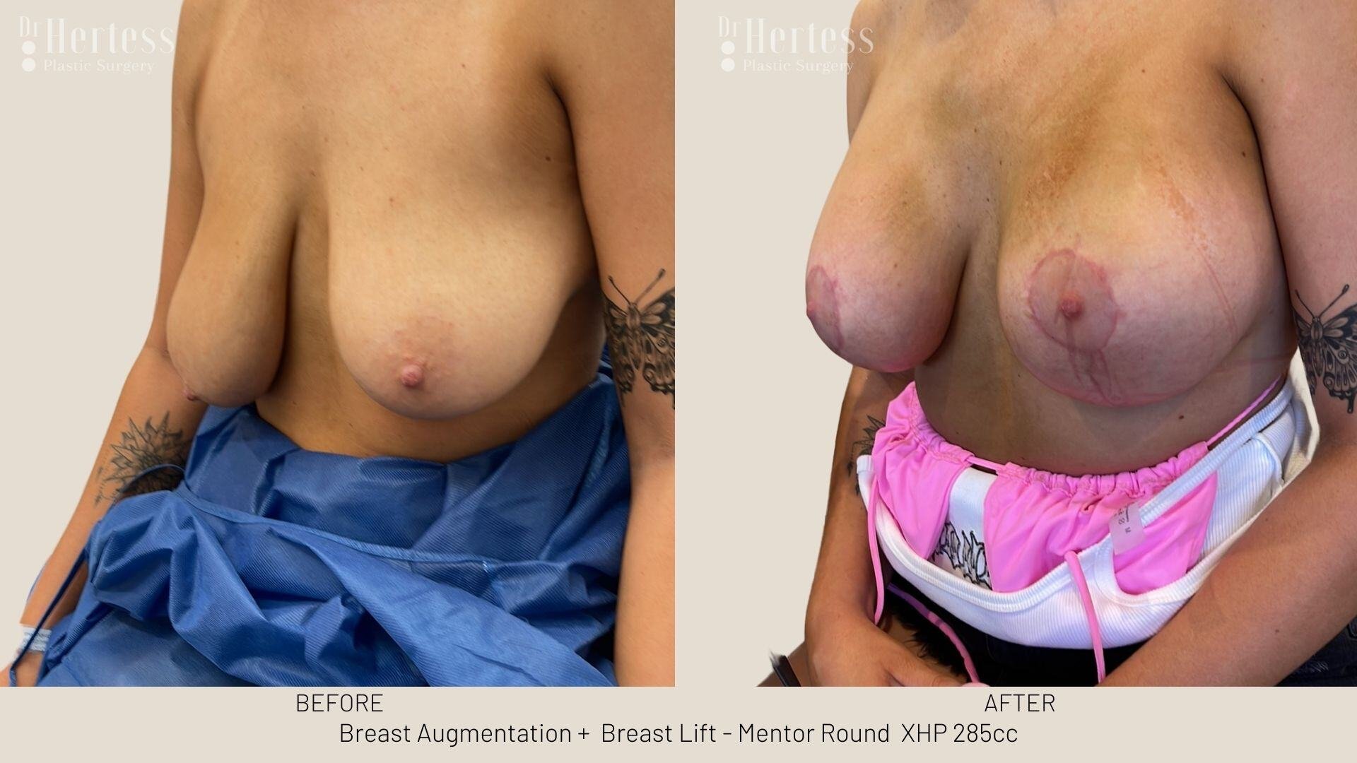 implants and lift before and after