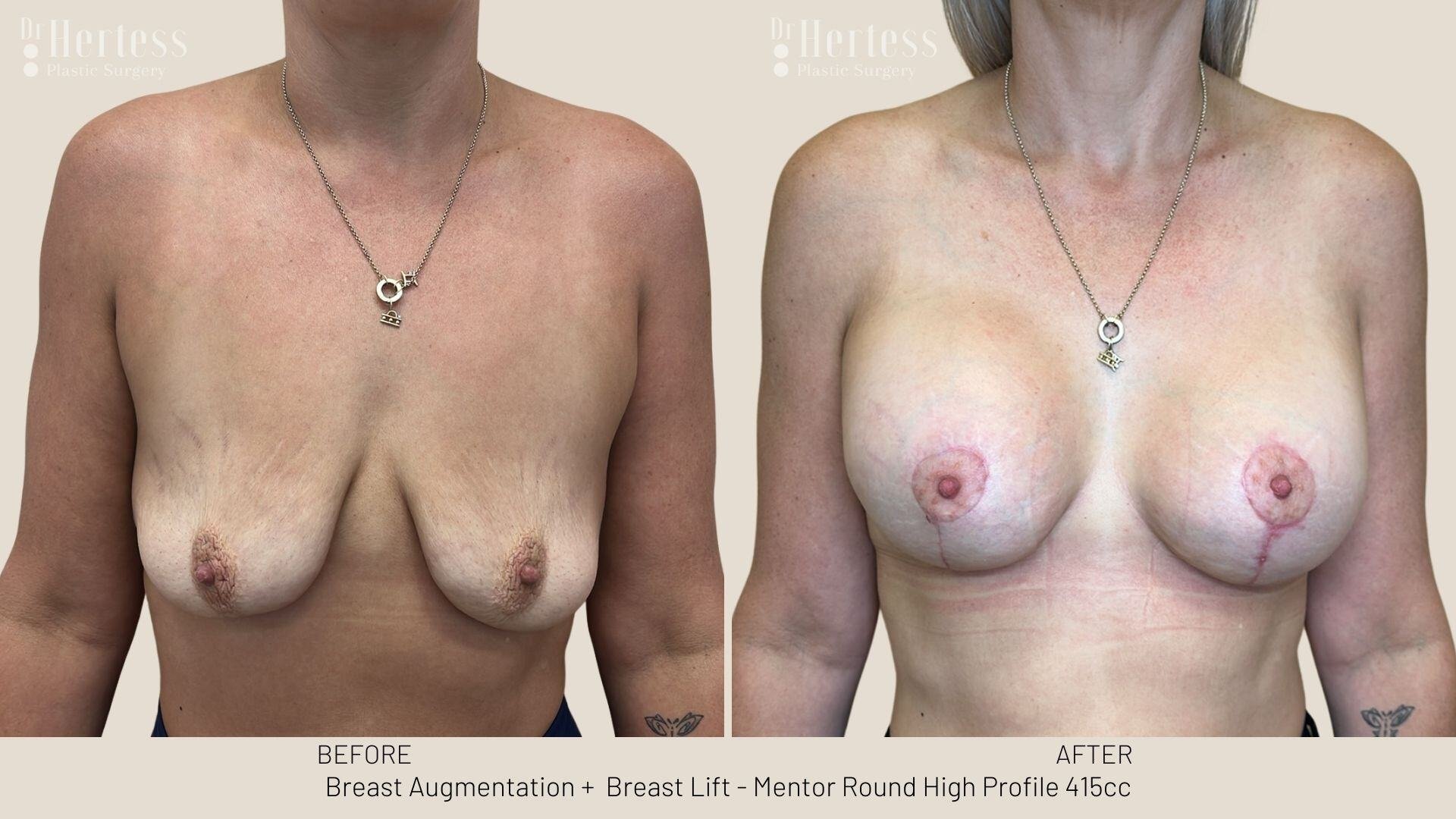 implants and lift before and after