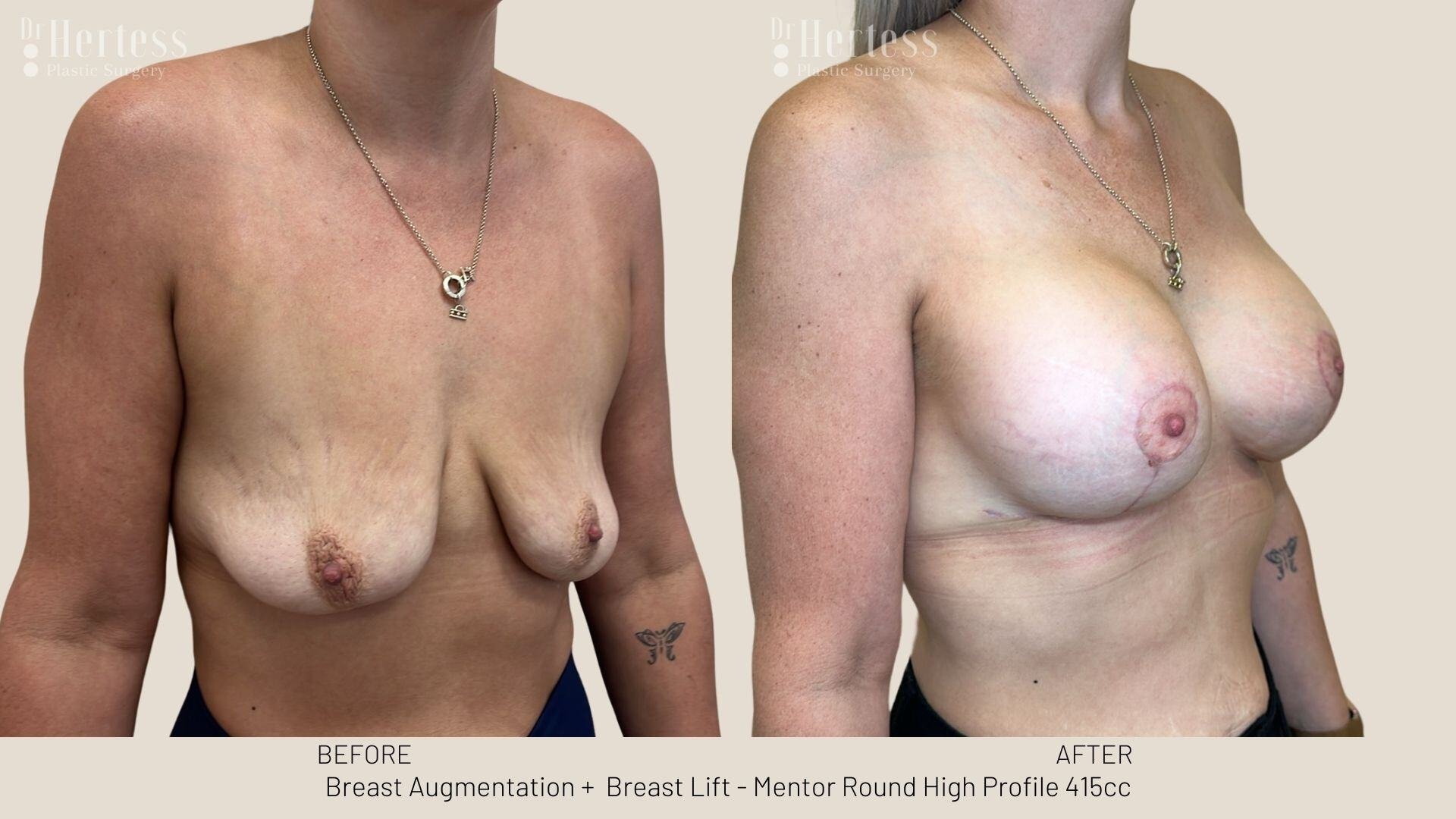 implants and lift before and after