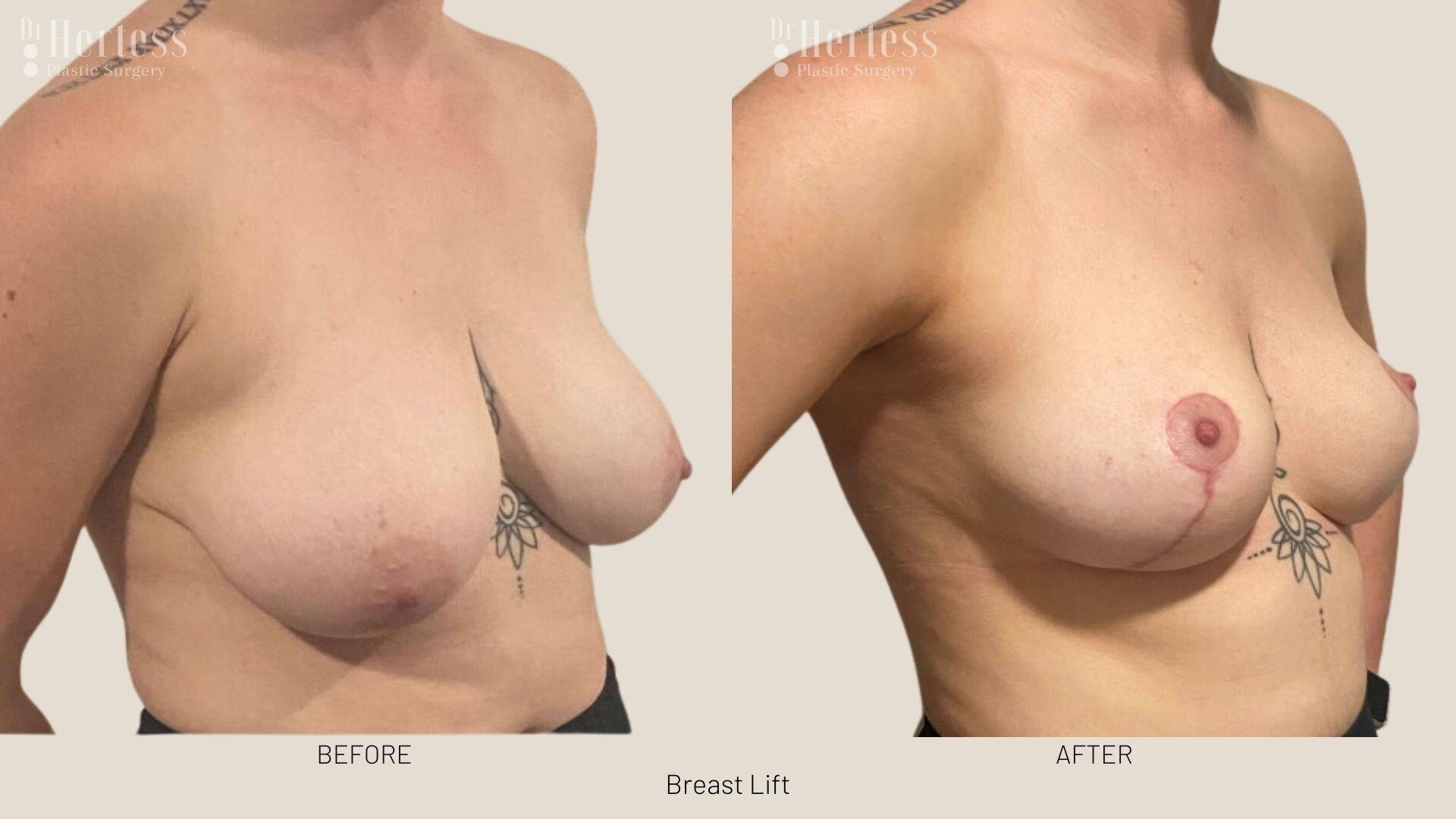breast lift before and after