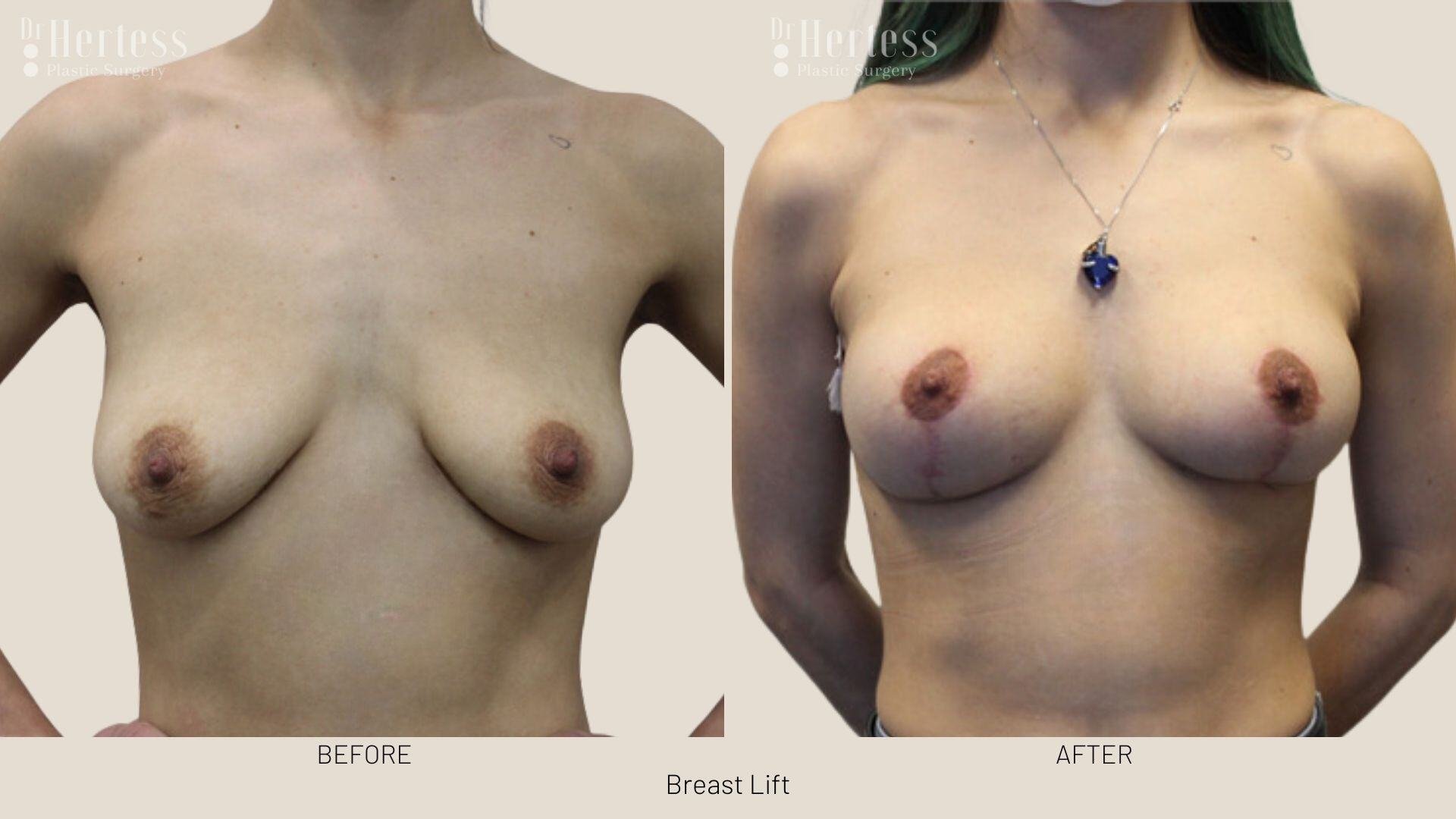 breast lift before and after