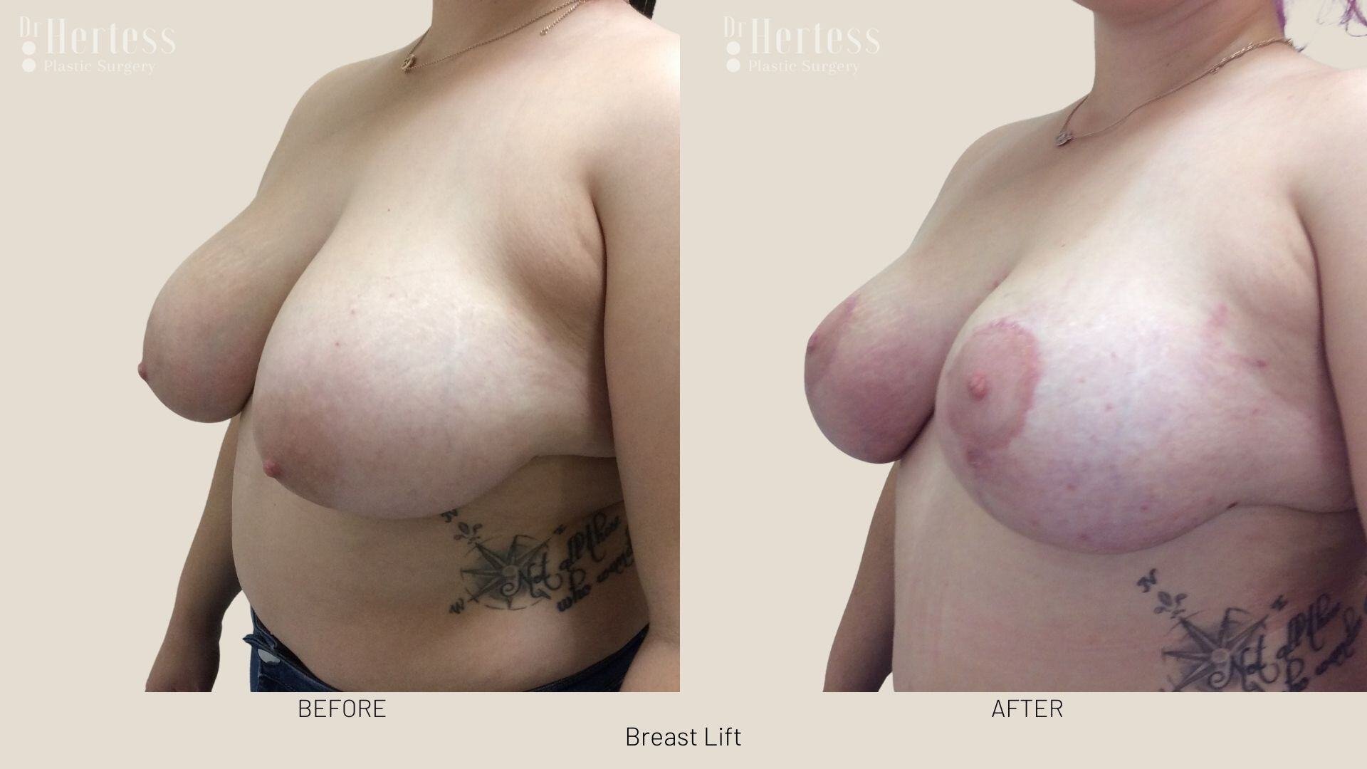 breast lift before and after