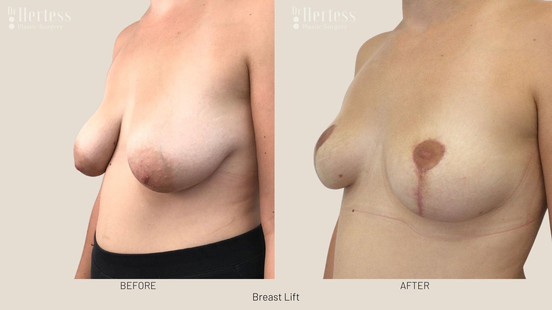 breast lift before and after