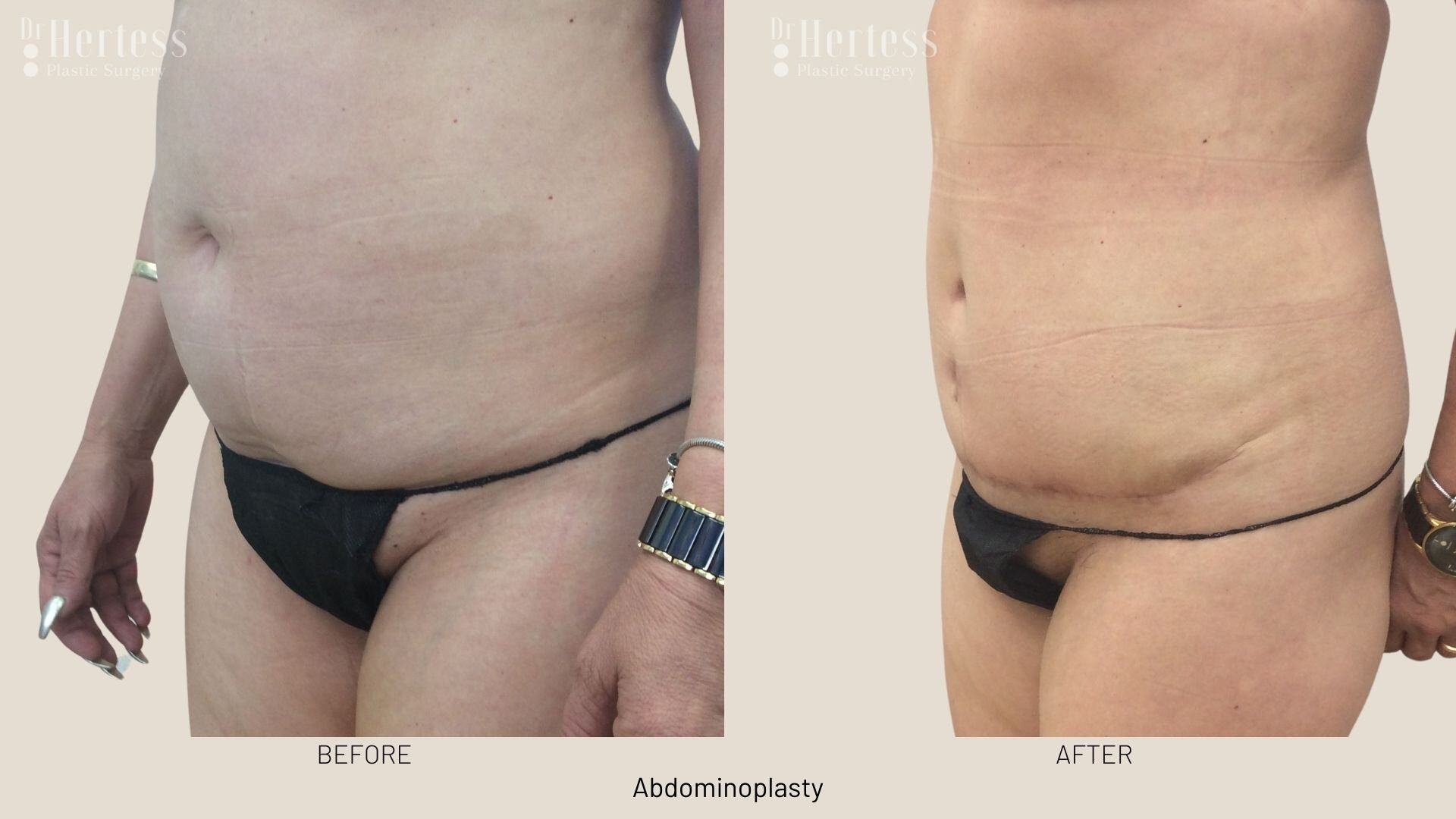 abdominoplasty before and after photos