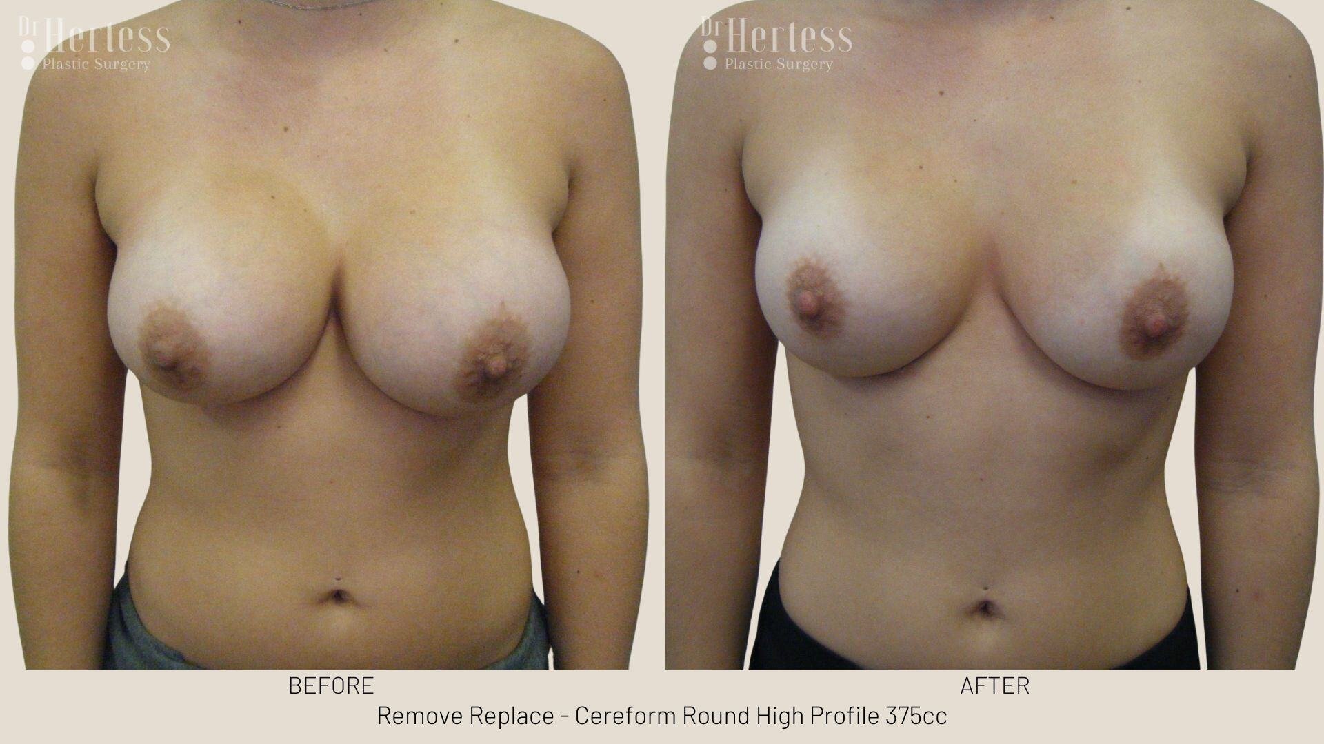 remove replace breast implants photos