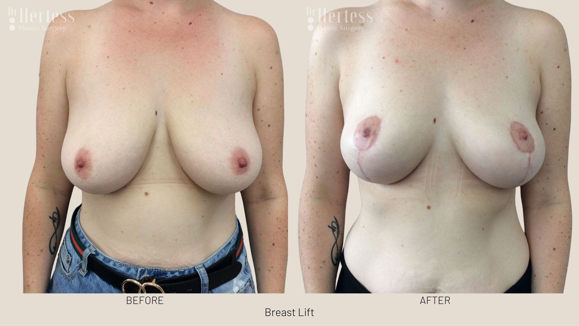 breast lift before and after