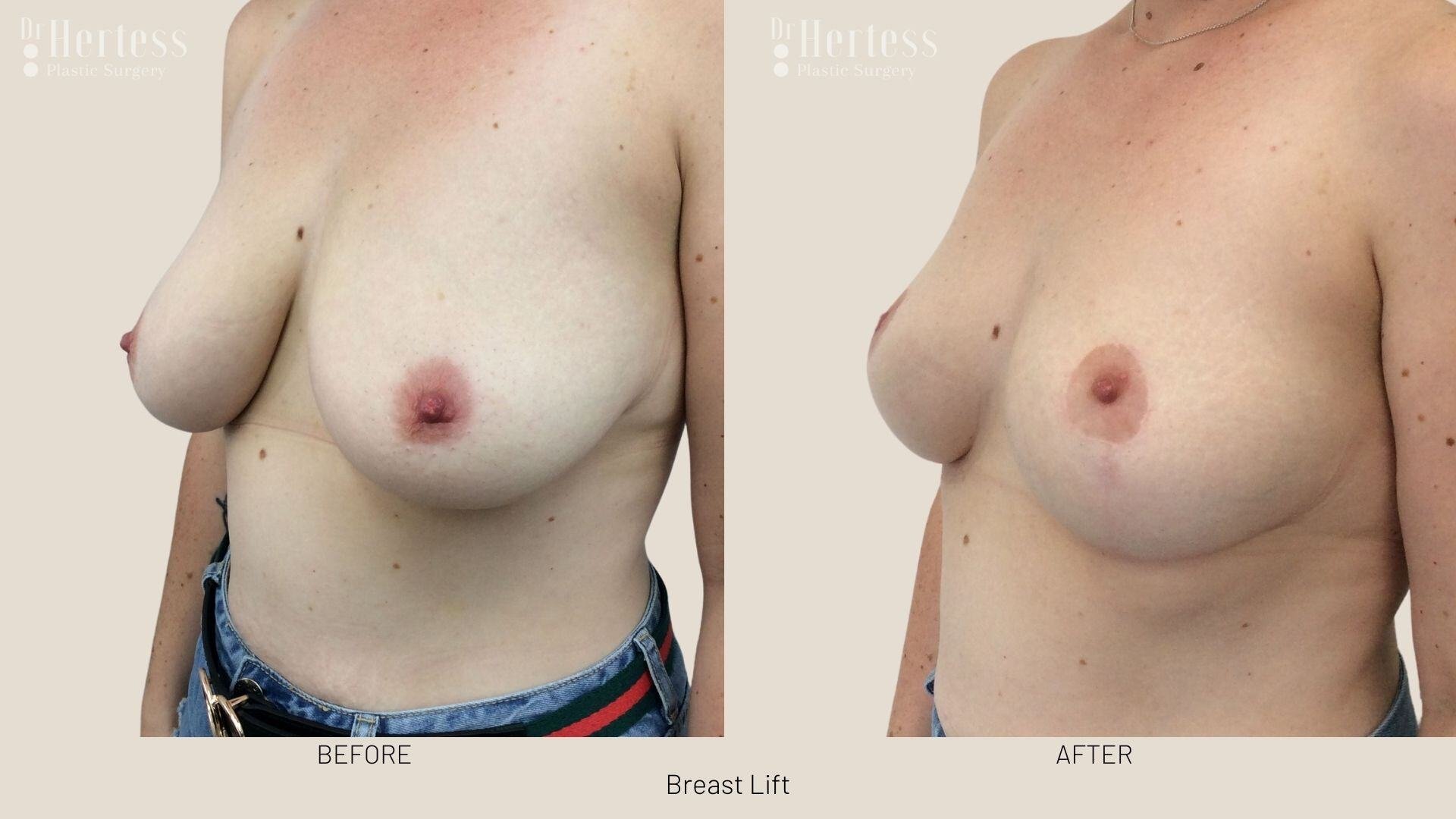 breast lift before and after