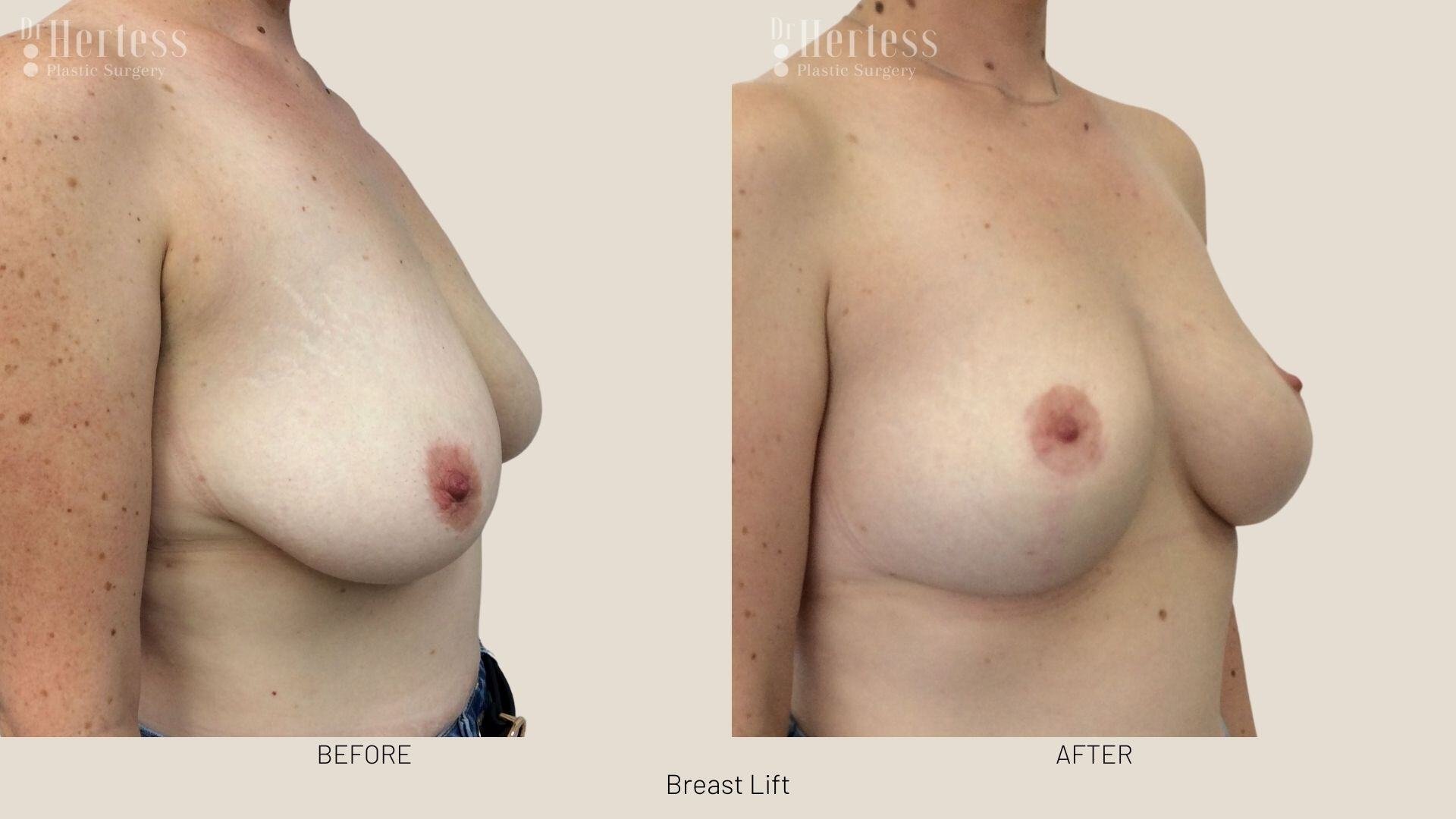 breast lift before and after