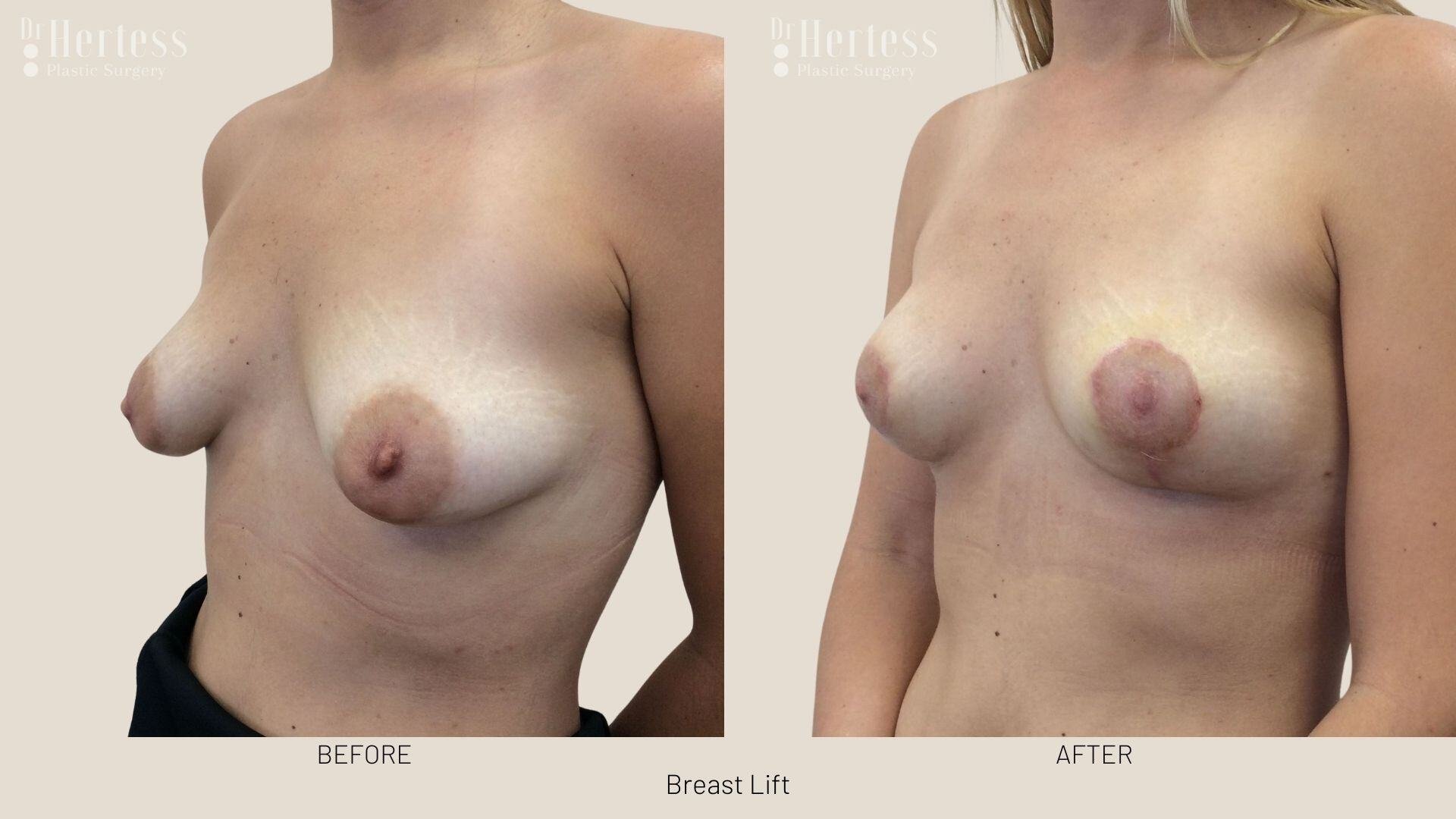 breast lift before and after