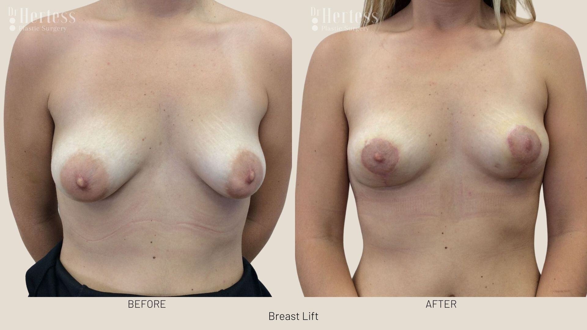 breast lift before and after