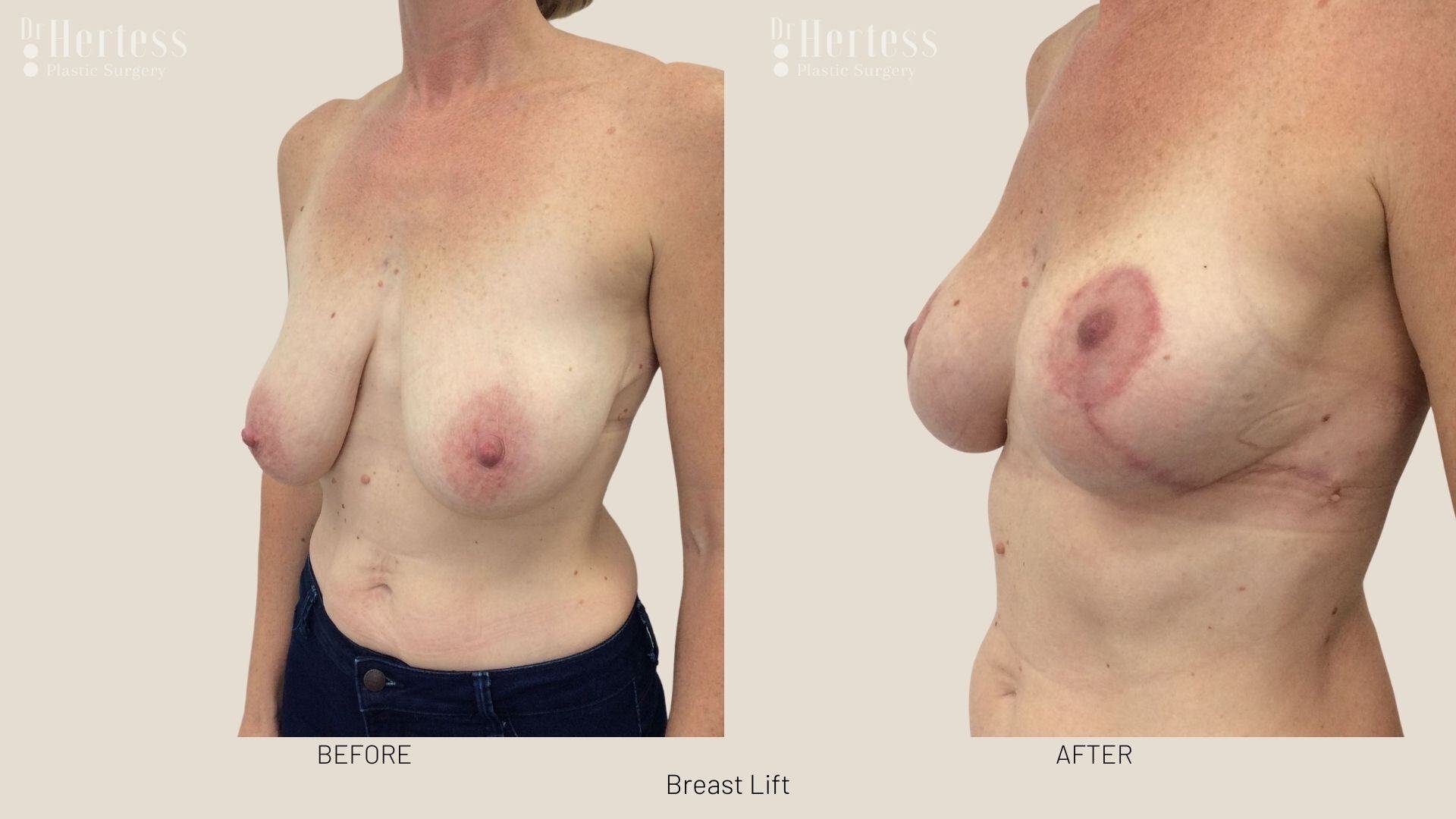 breast lift before and after