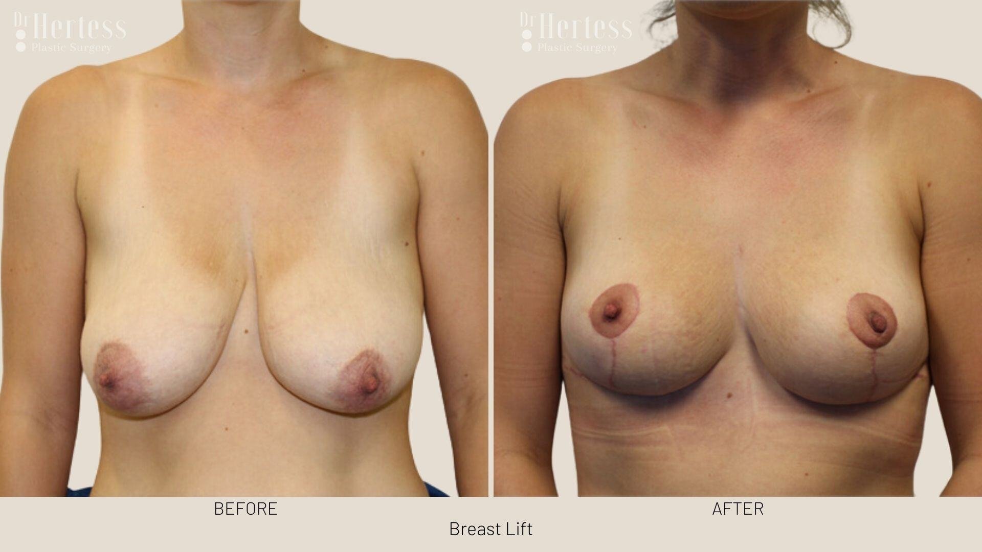 breast lift before and after