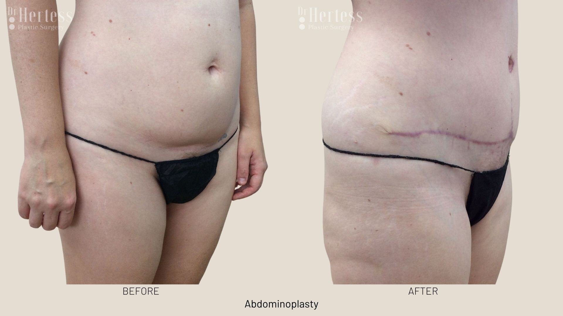 abdominoplasty before and after photos