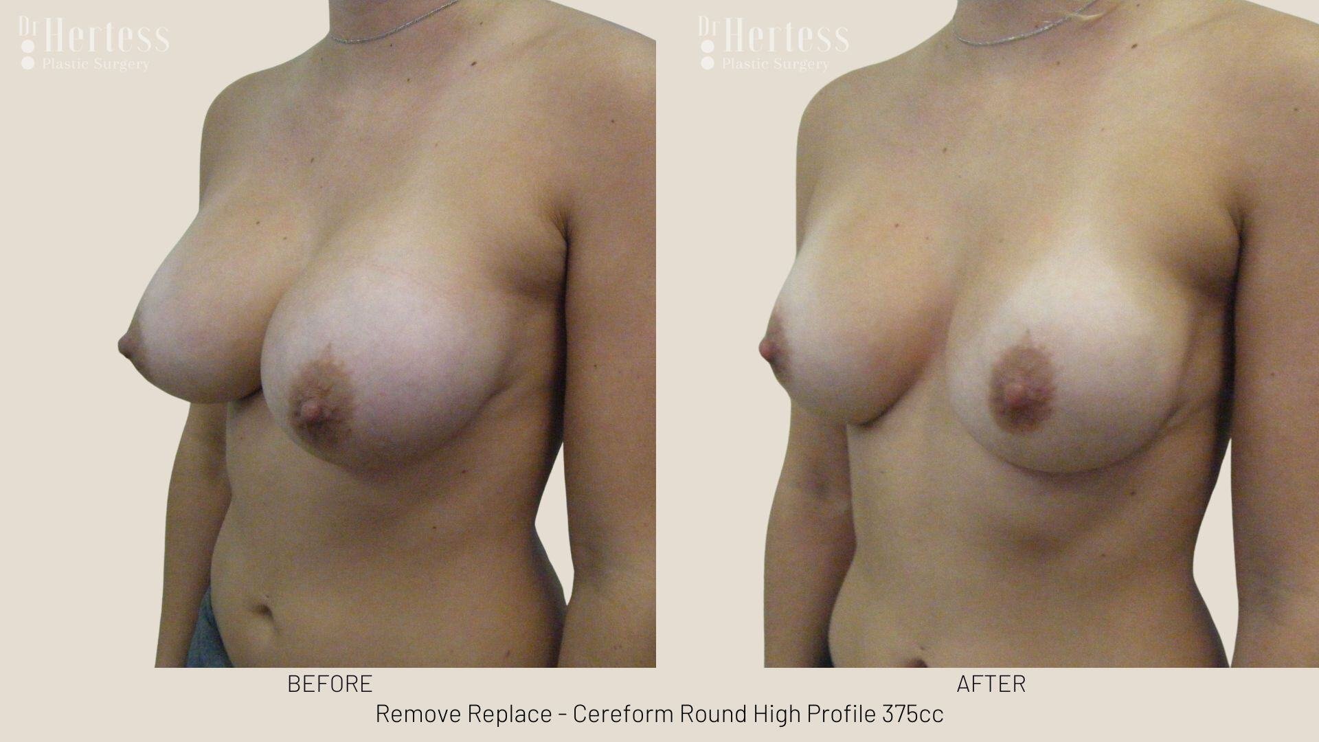 remove replace breast implants photos