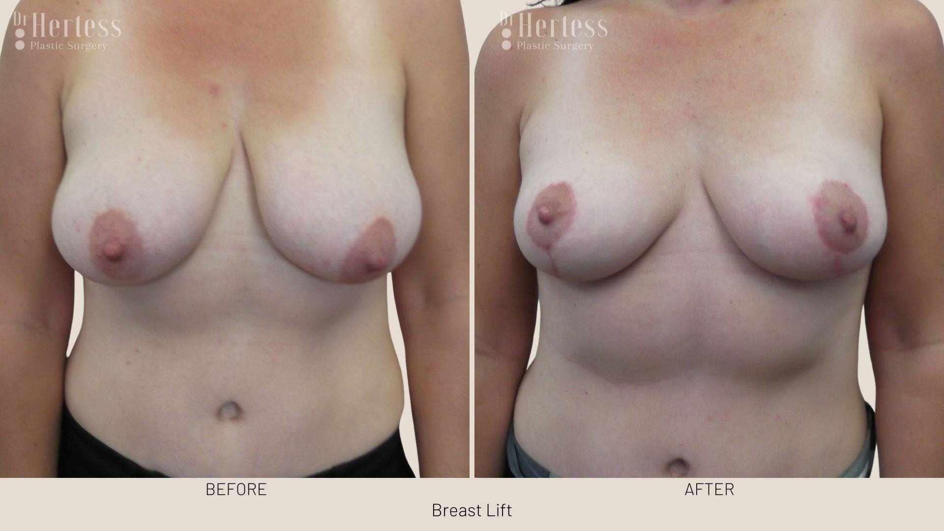 breast lift before and after