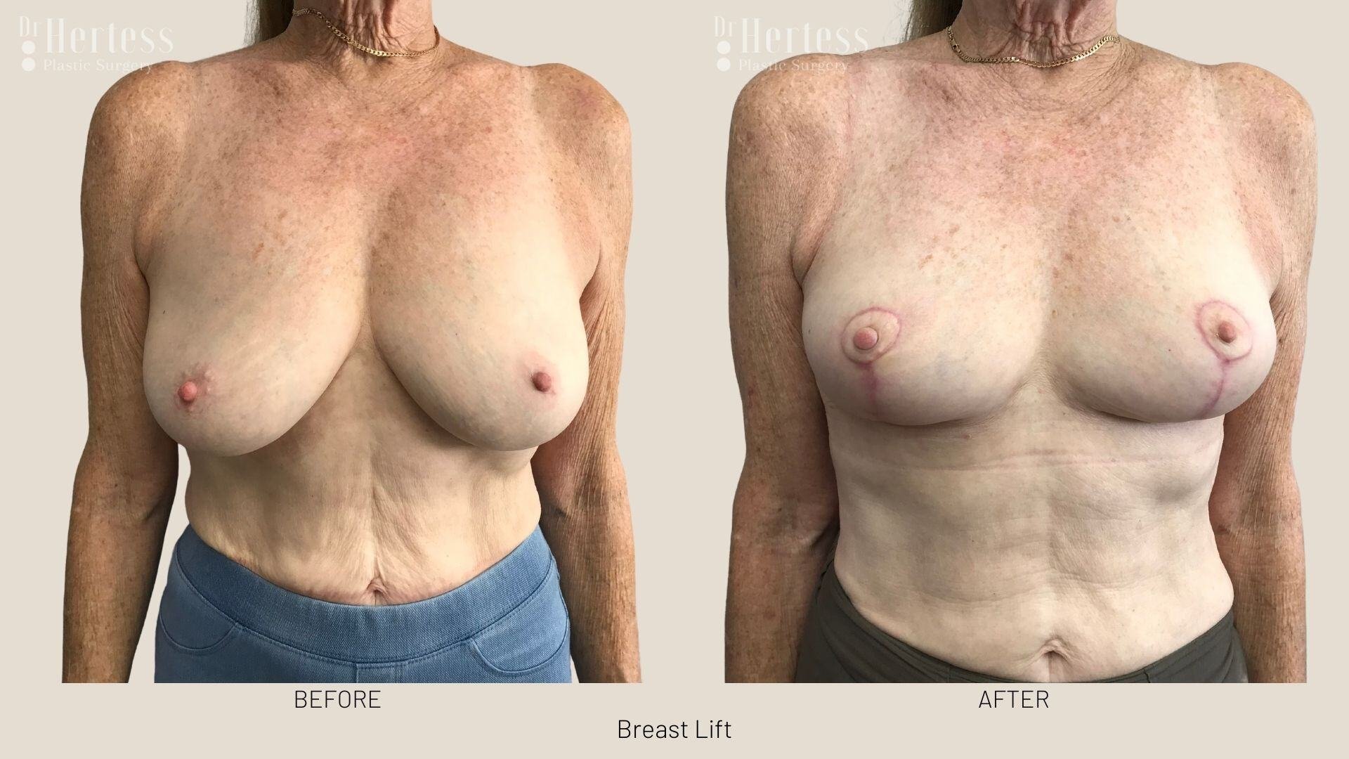 breast lift before and after