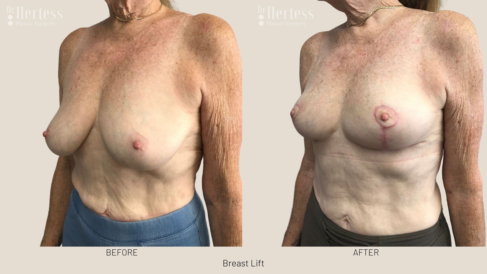 breast lift before and after