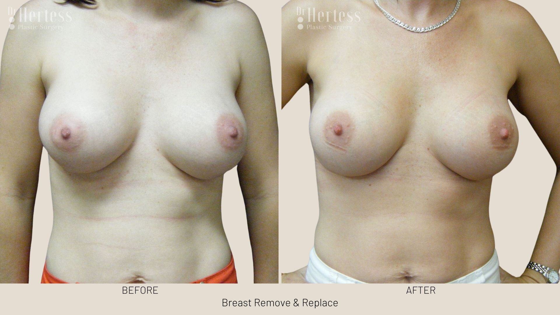 remove replace breast implants photos