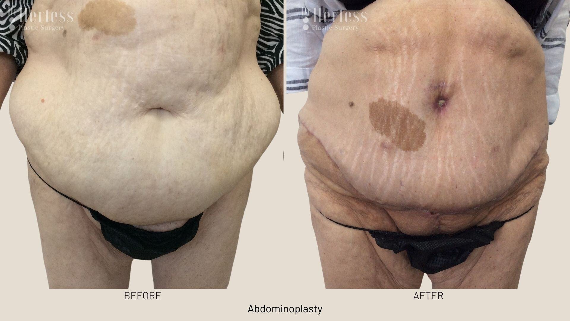 tummy tuck before and after