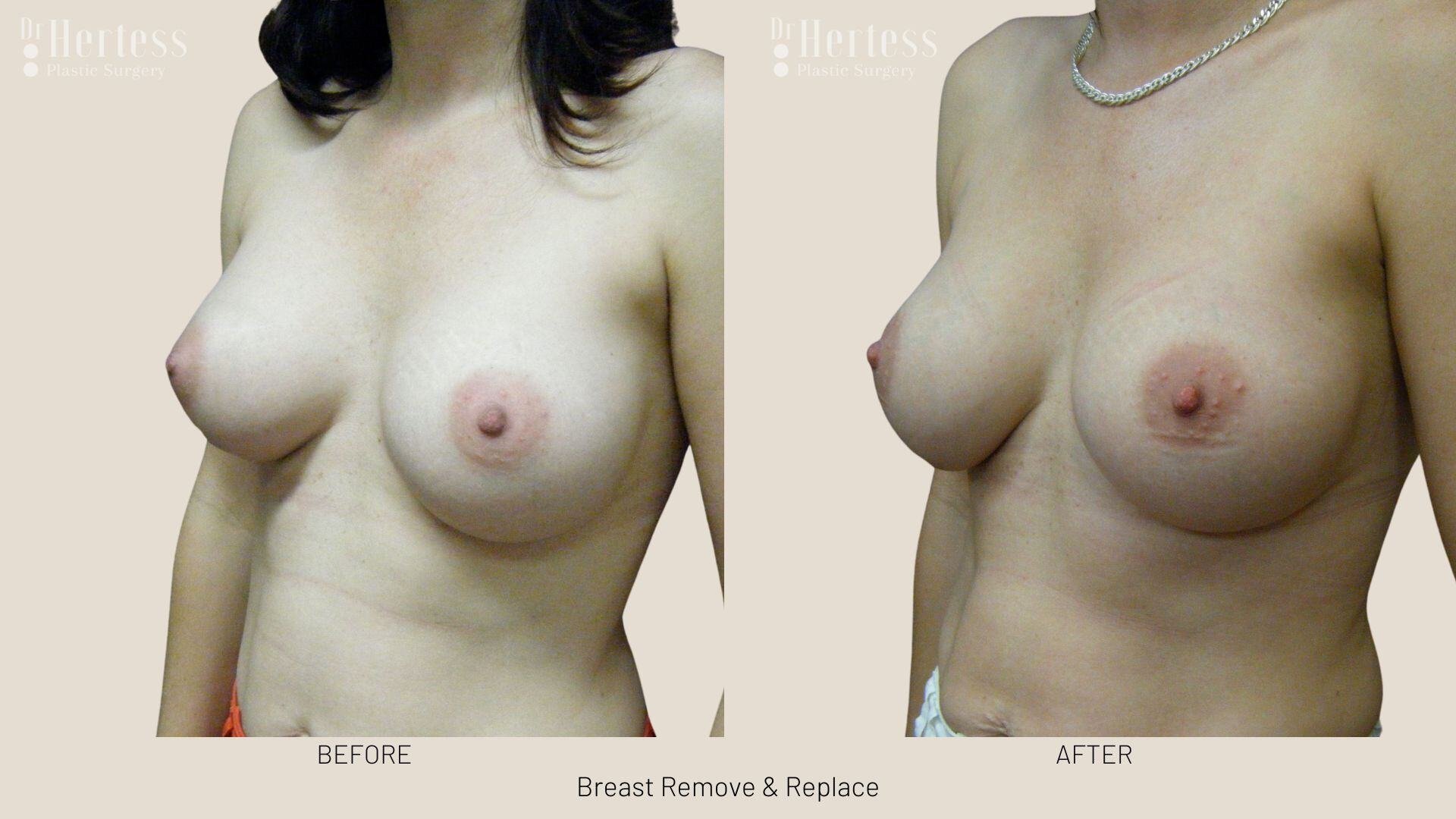 remove replace breast implants photos