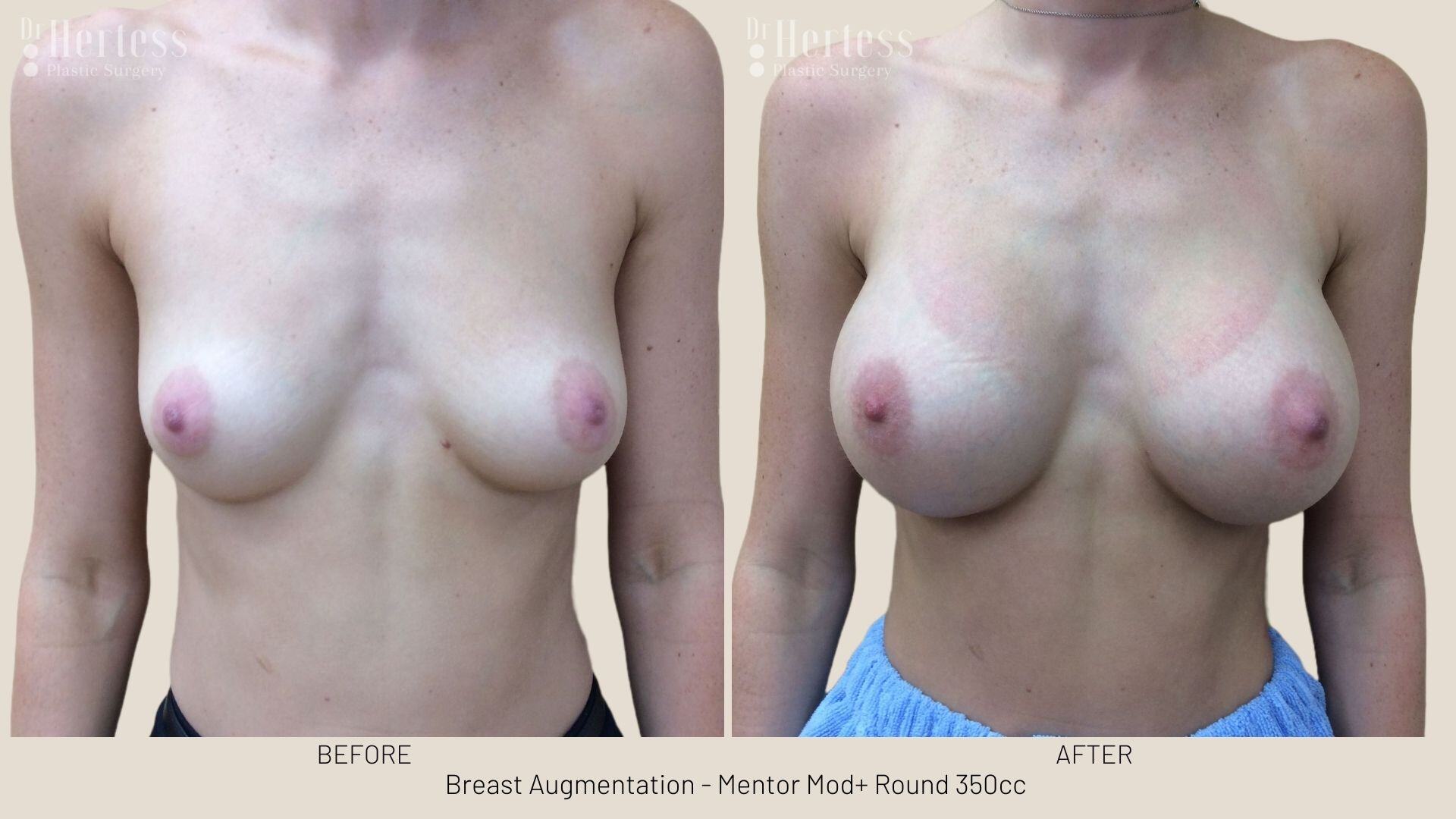 breast implant photos before and after