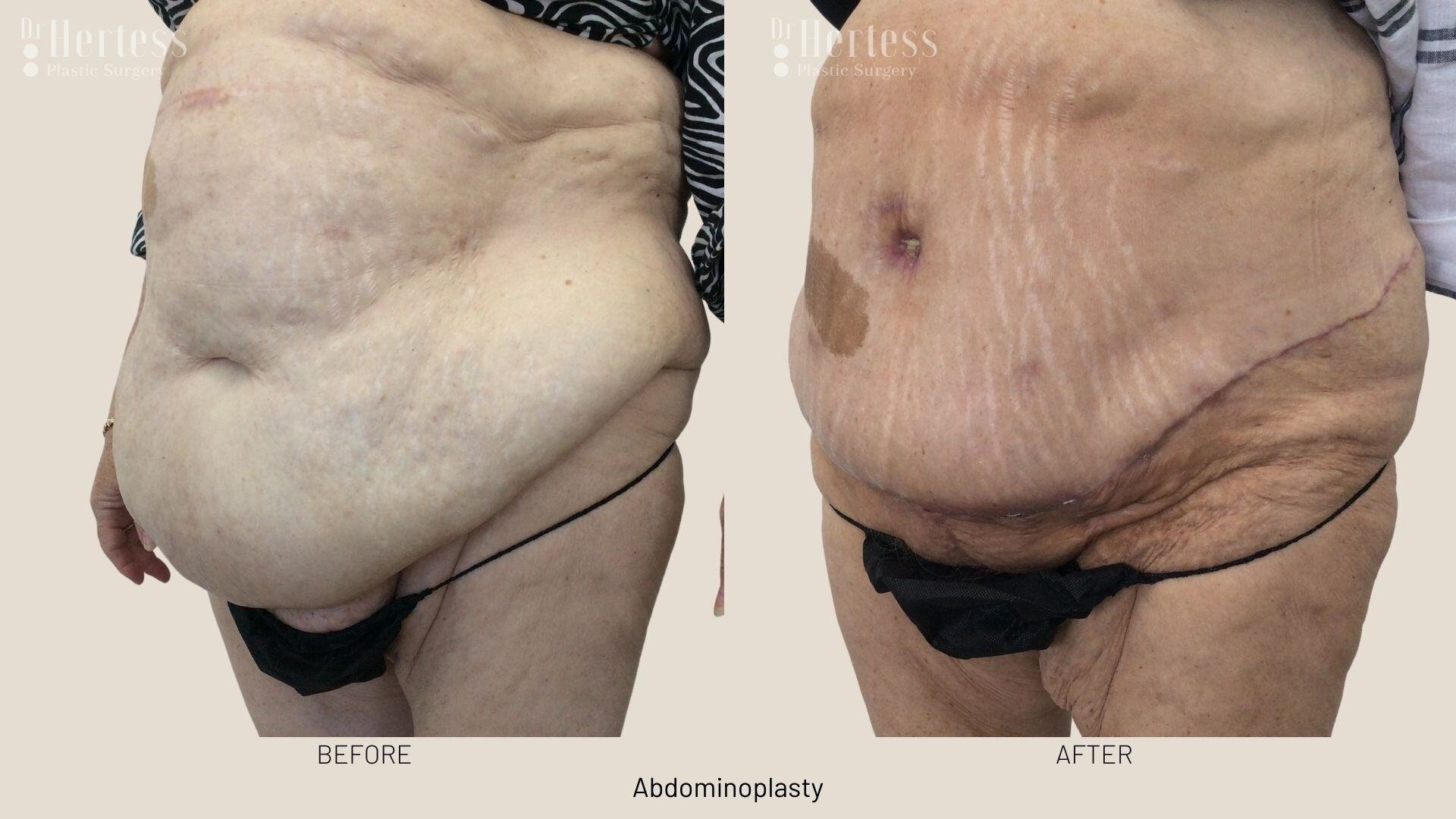 tummy tuck before and after