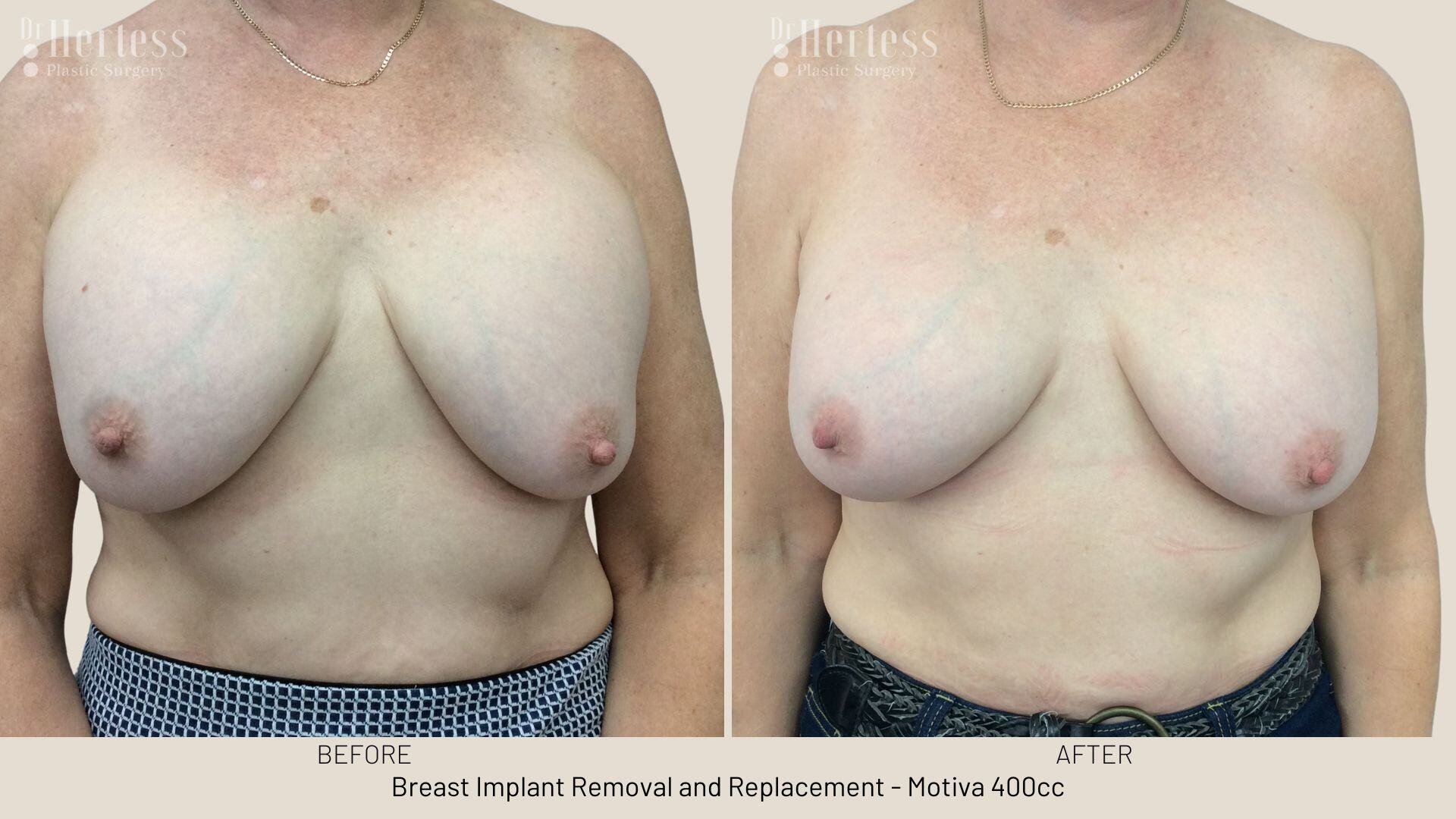 remove replace breast implants photos