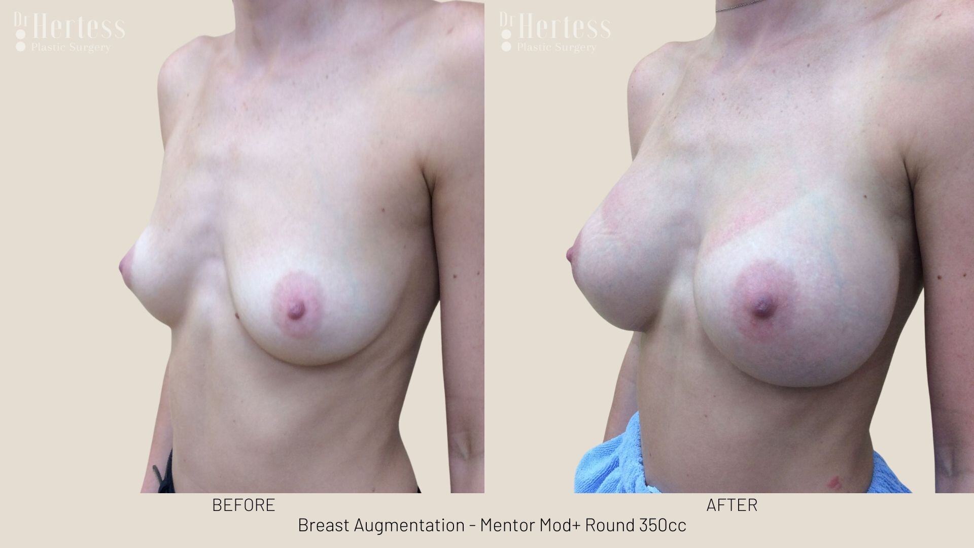 breast implant photos before and after