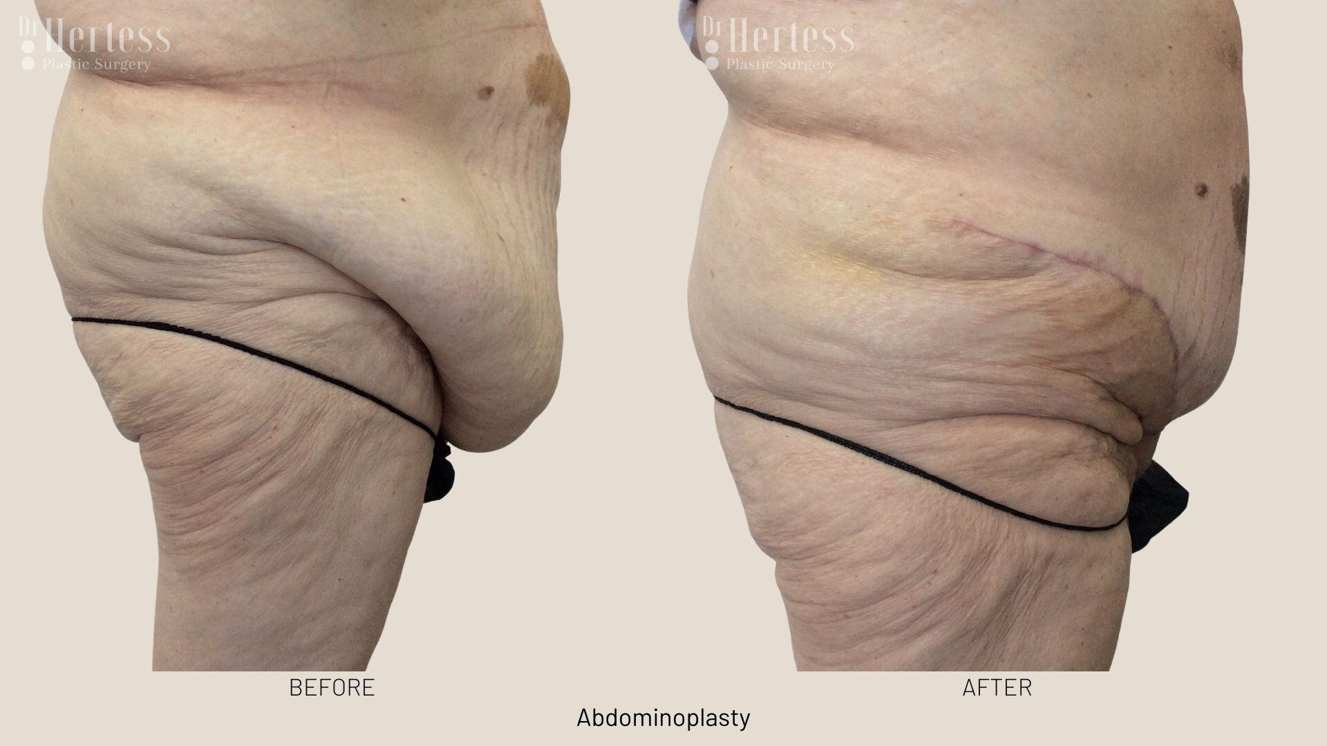 tummy tuck before and after