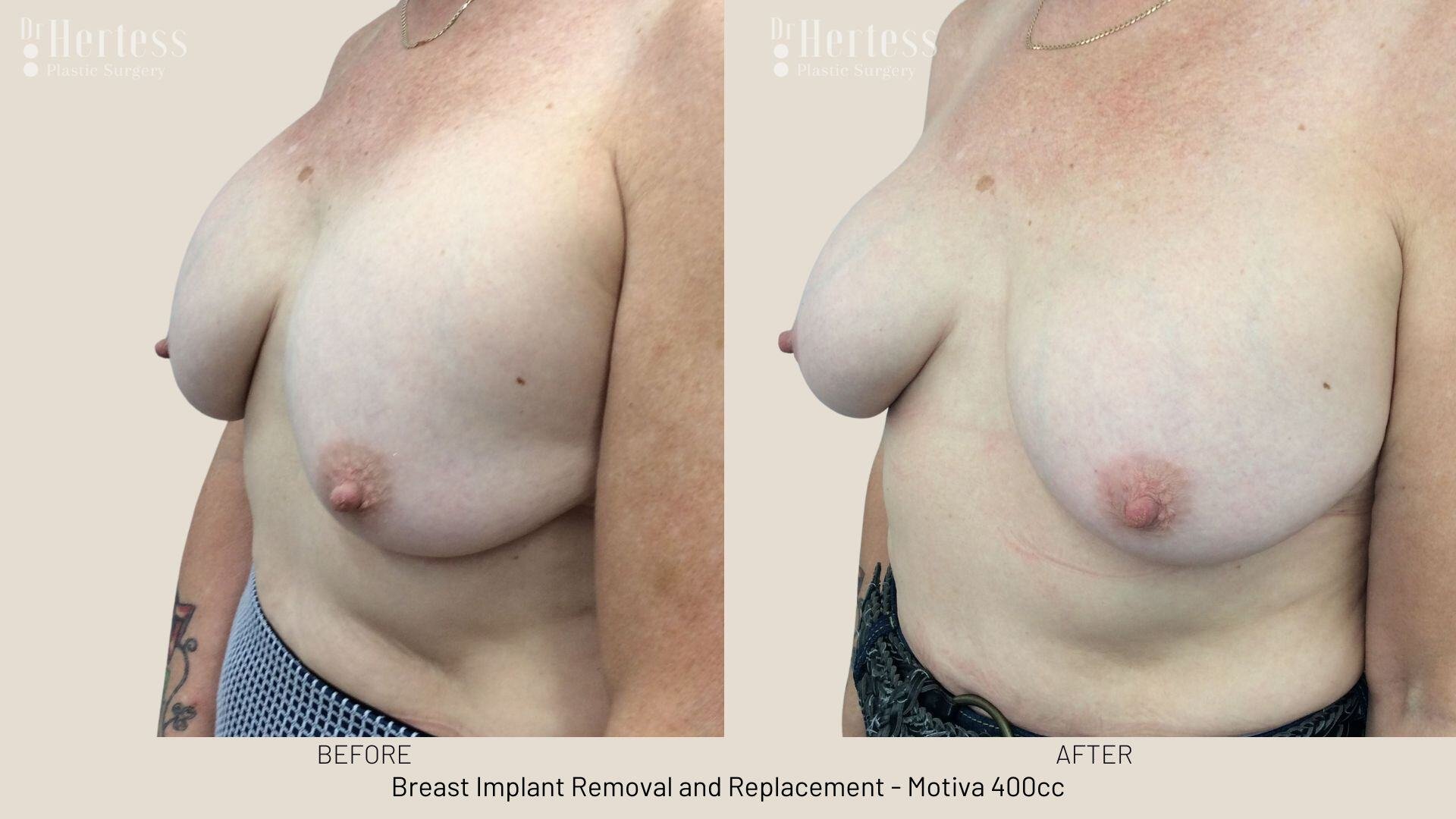remove replace breast implants photos
