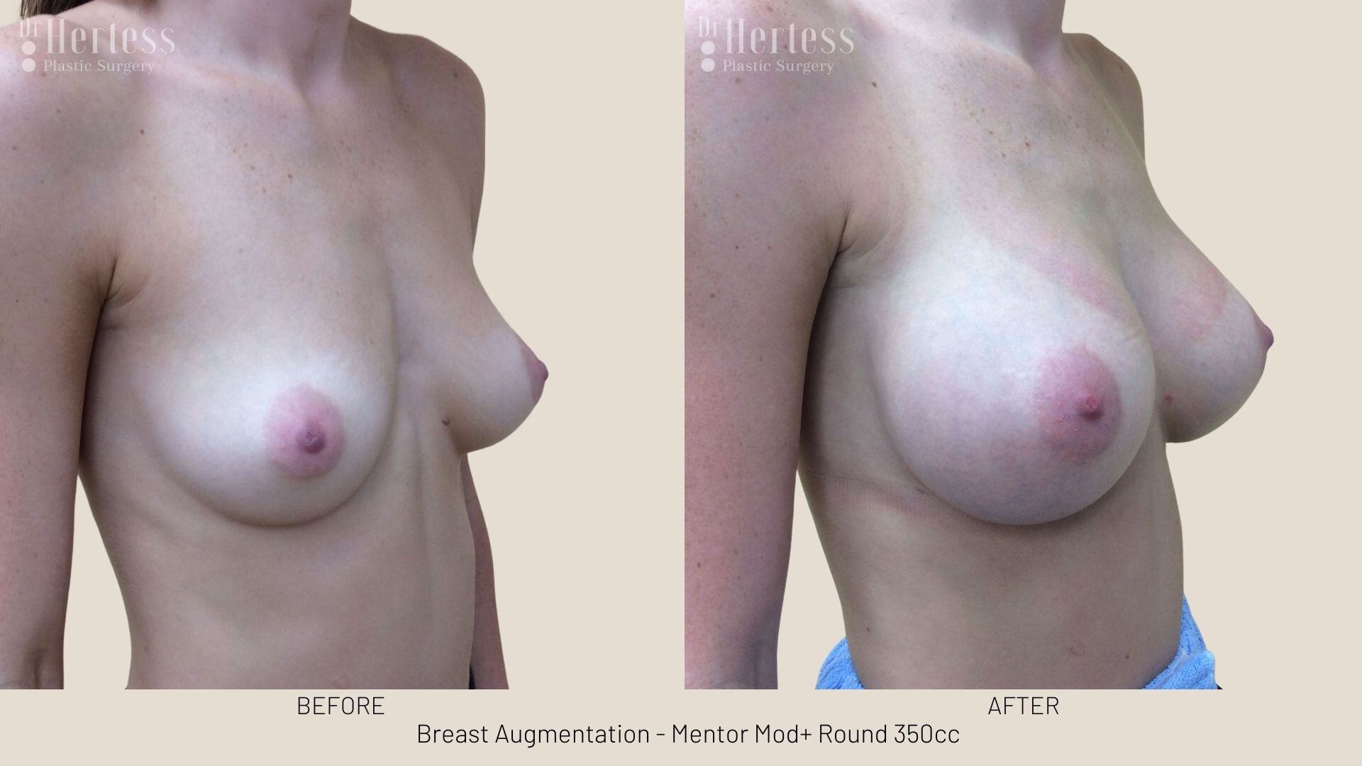 breast implant photos before and after