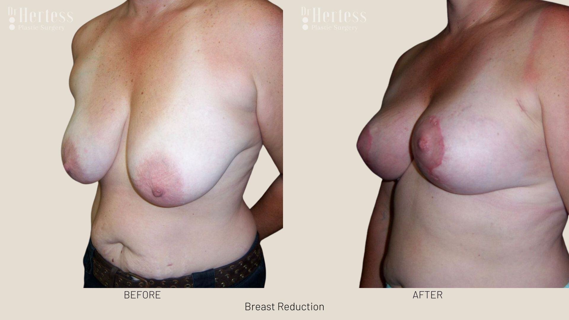breast reduction before and after