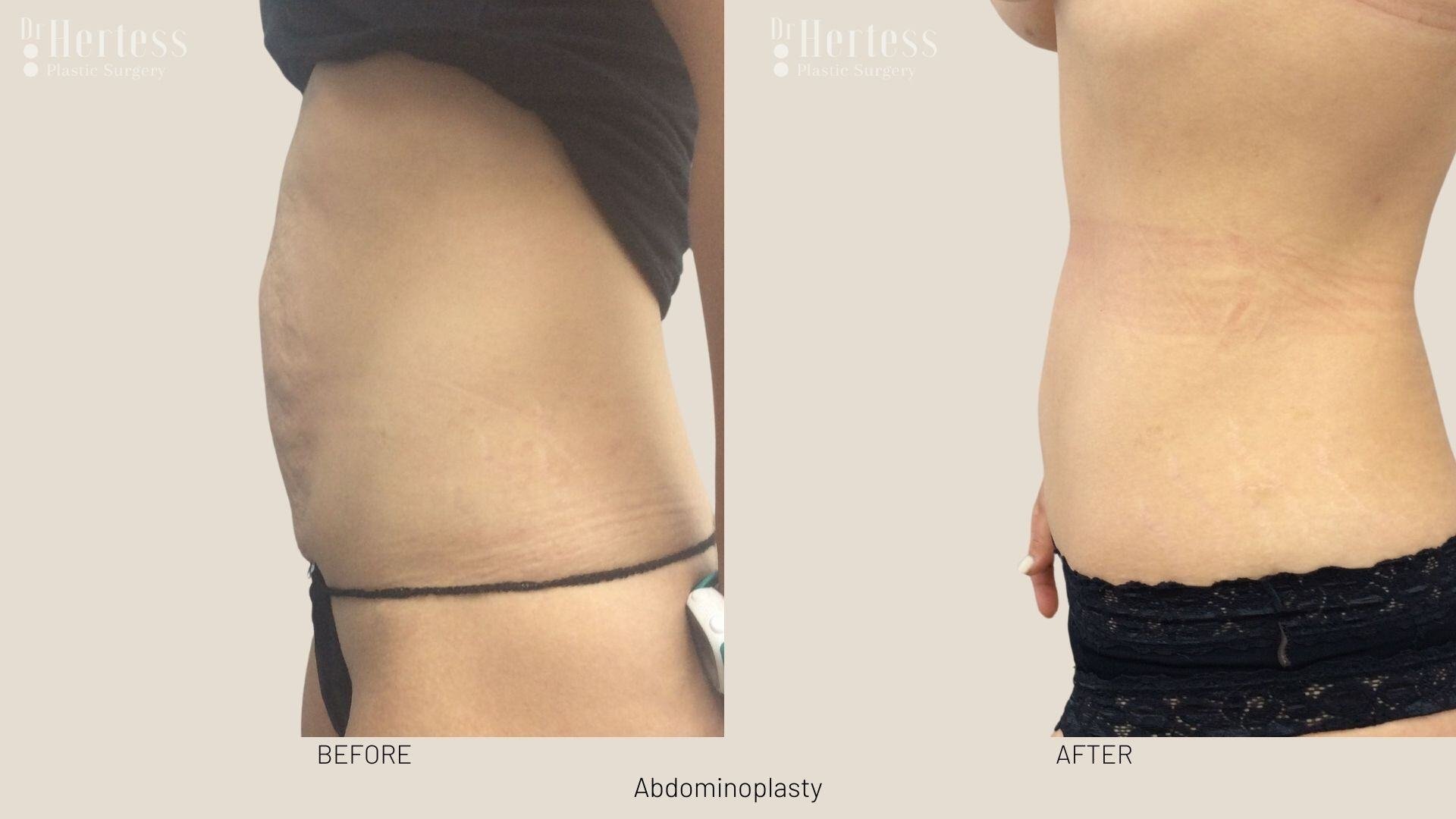 abdominoplasty before and after photos