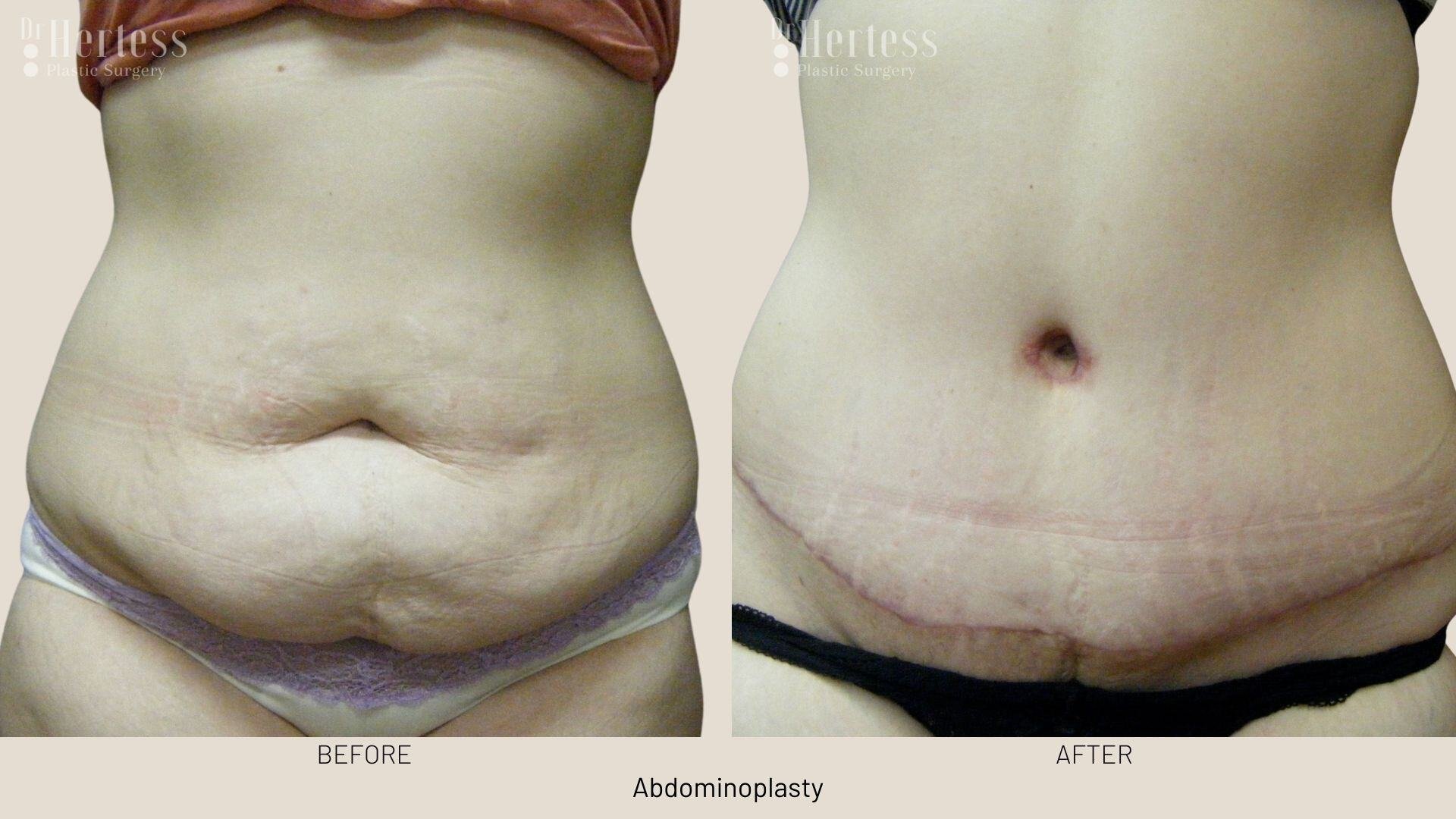 tummy tuck before and after
